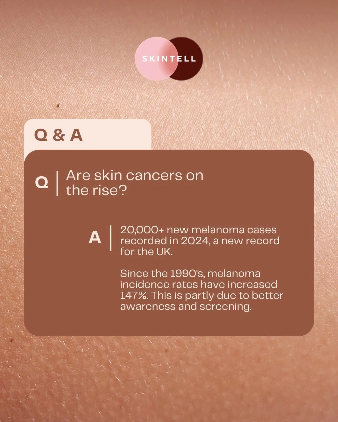 Your Skin Has a Story to Tell

Tracking isn&rsquo;t just about looking, it&rsquo;s about monitoring the change over time. Swipe through for some interesting stats about skin cancer in the UK. 

If you are simply worried about one or two specific lesi