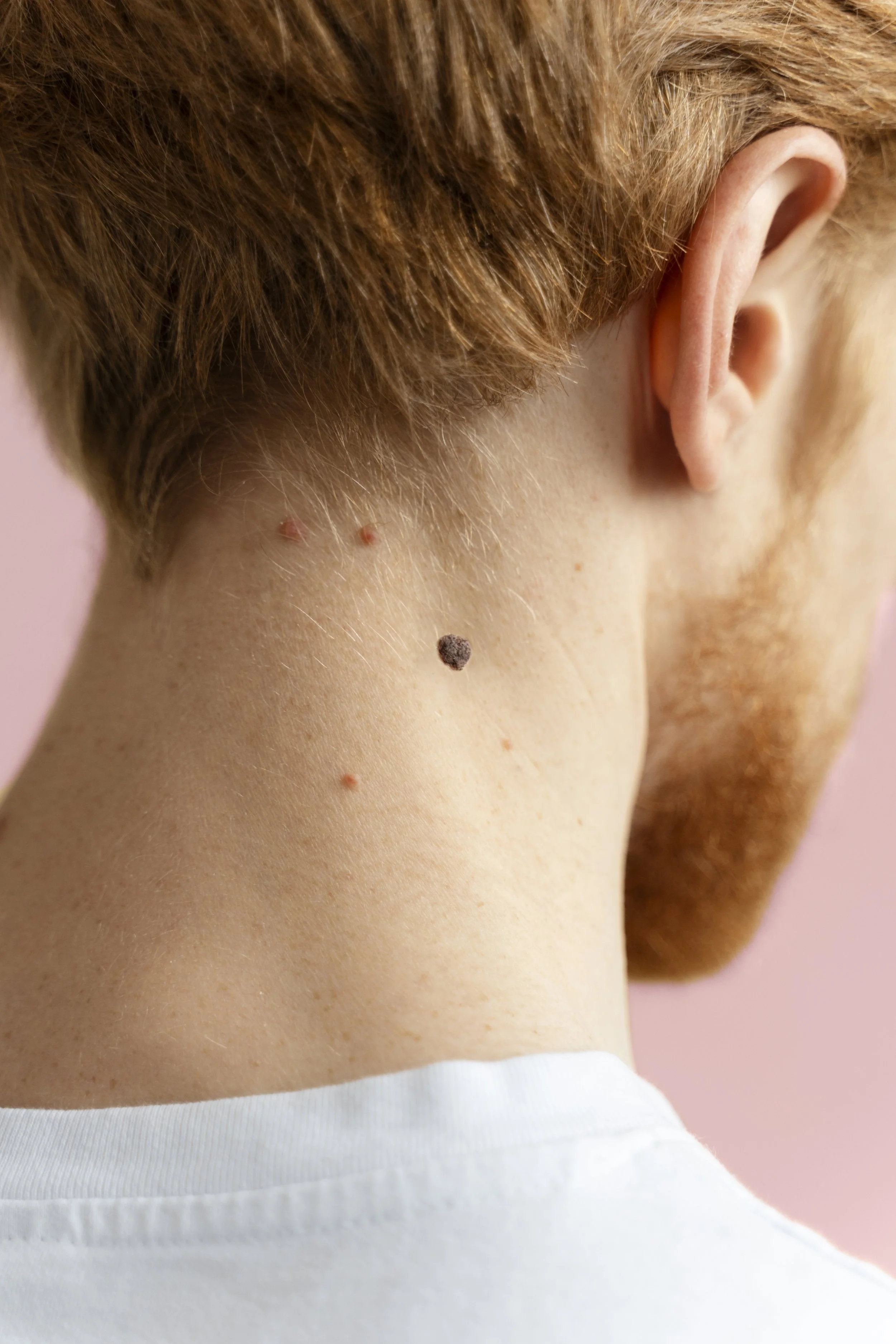 Close-up of the back of a person's neck, showing several moles and skin markings.
