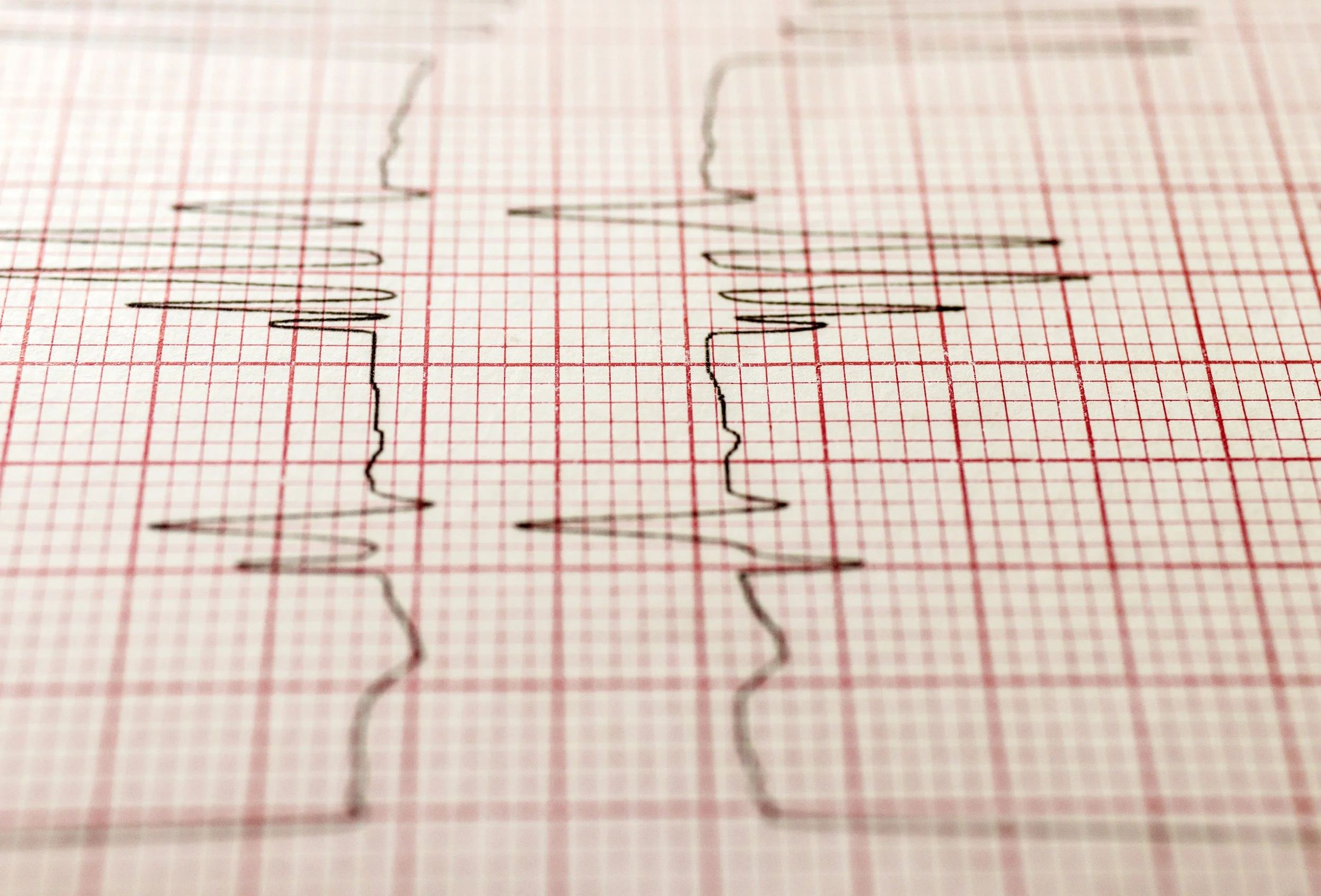What Is a CTG Trace?