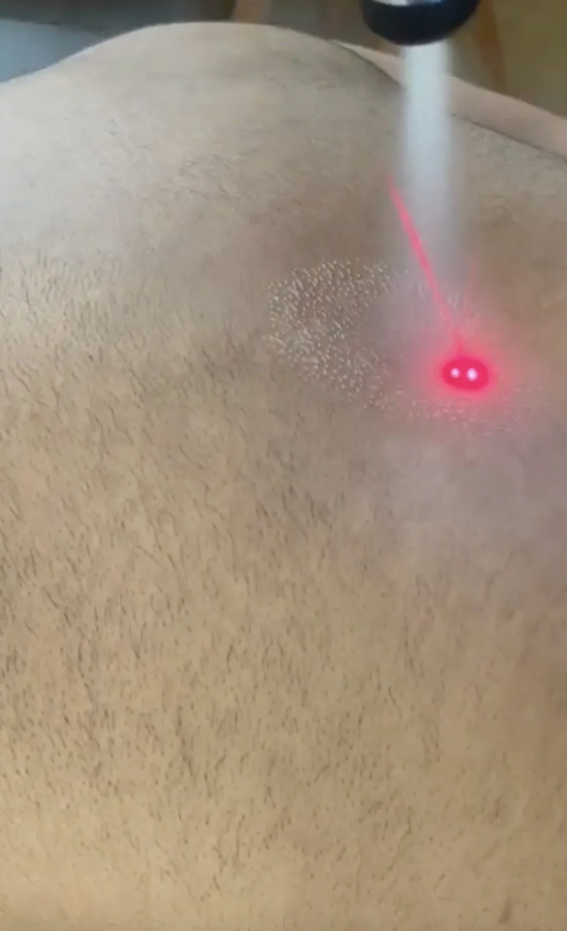 Cryotherapy-Handheld