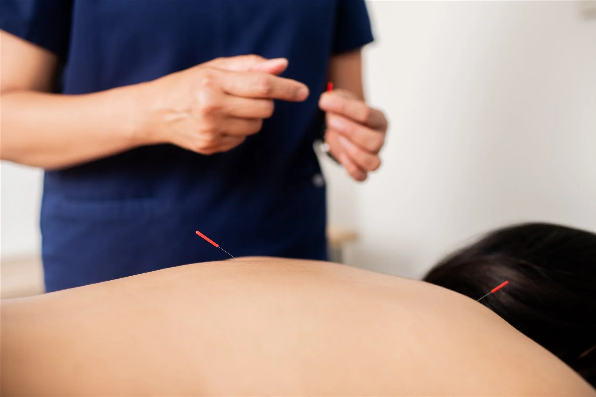 Acupuncturist Grace Killpack performing acupuncture on a patient's back at her clinic Apo Acupuncture near Lafayette, CA.