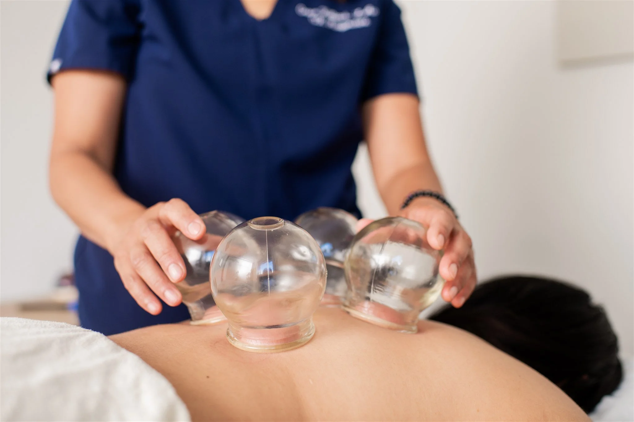 Acupuncturist Grace Killpack performing cupping on a patient's back at her clinic Apo Acupuncture near Lafayette, CA.