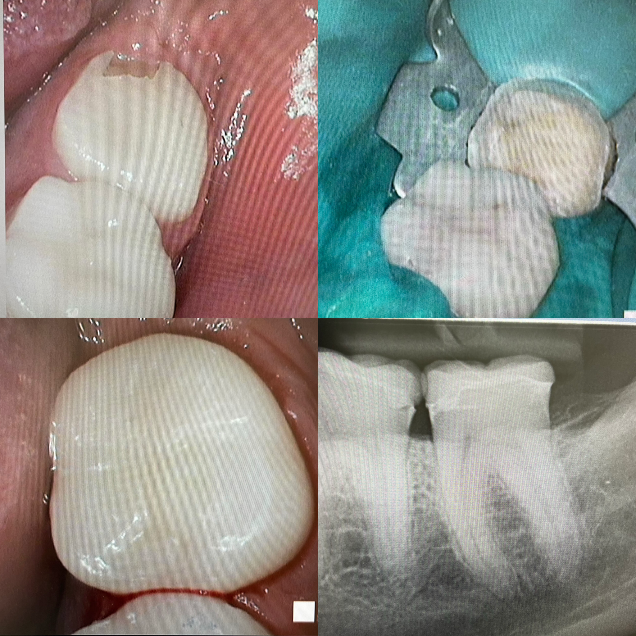 broken onlay, treatment steps with new preparation, rubberdam and final luted onlay with x-ray