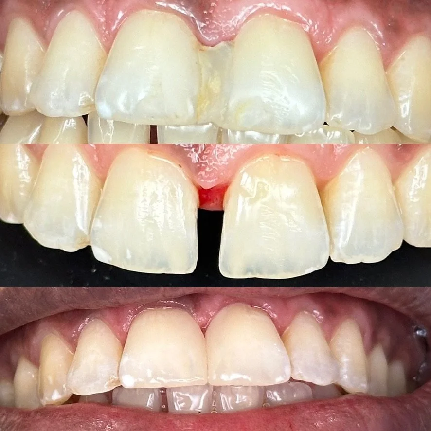3 Close-up fotos of the same teeth showing before, during, and after dental treatment of a bad diastema closure of the central incisors with visible improvements afterwards