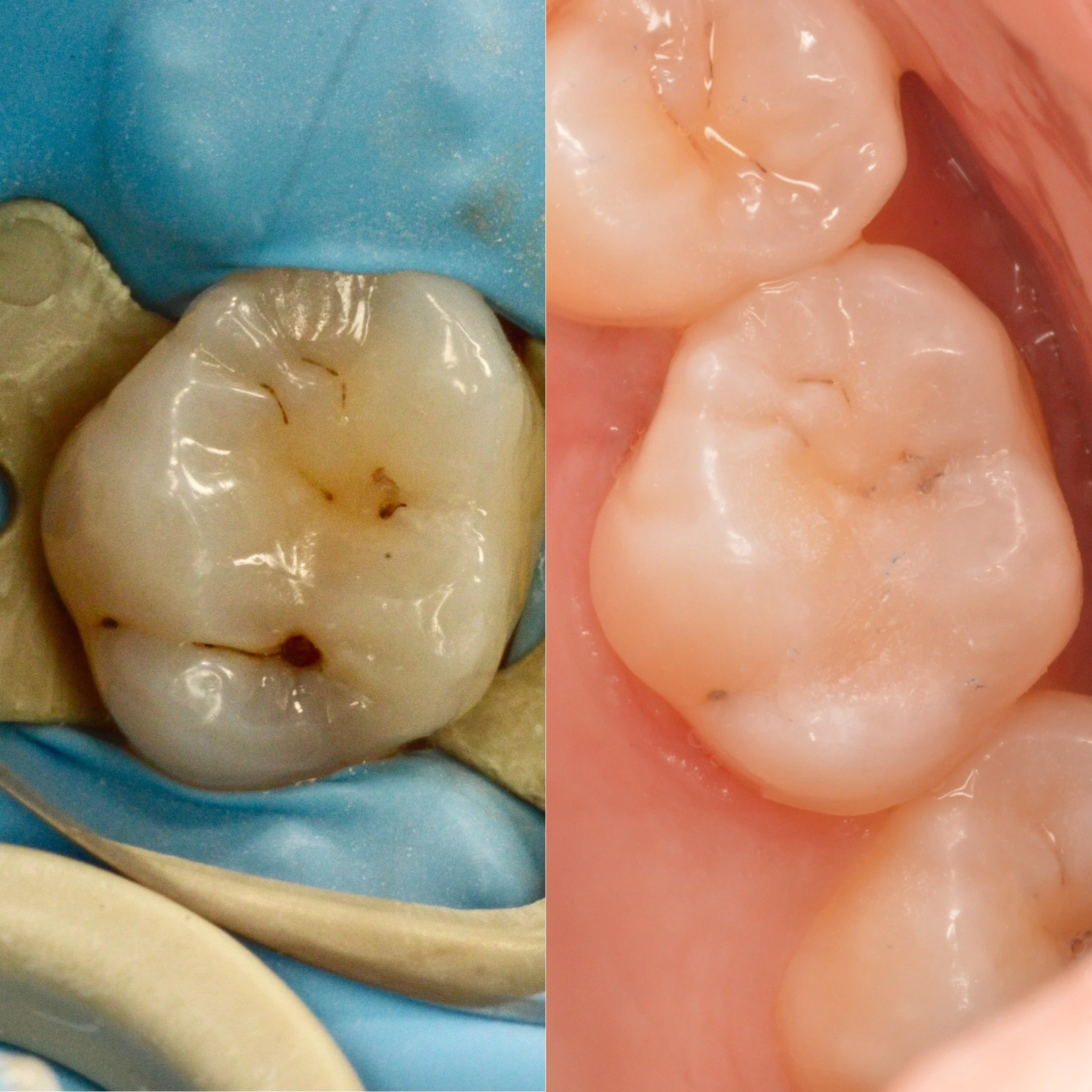 composite filling in upper molar, rubberdam placed