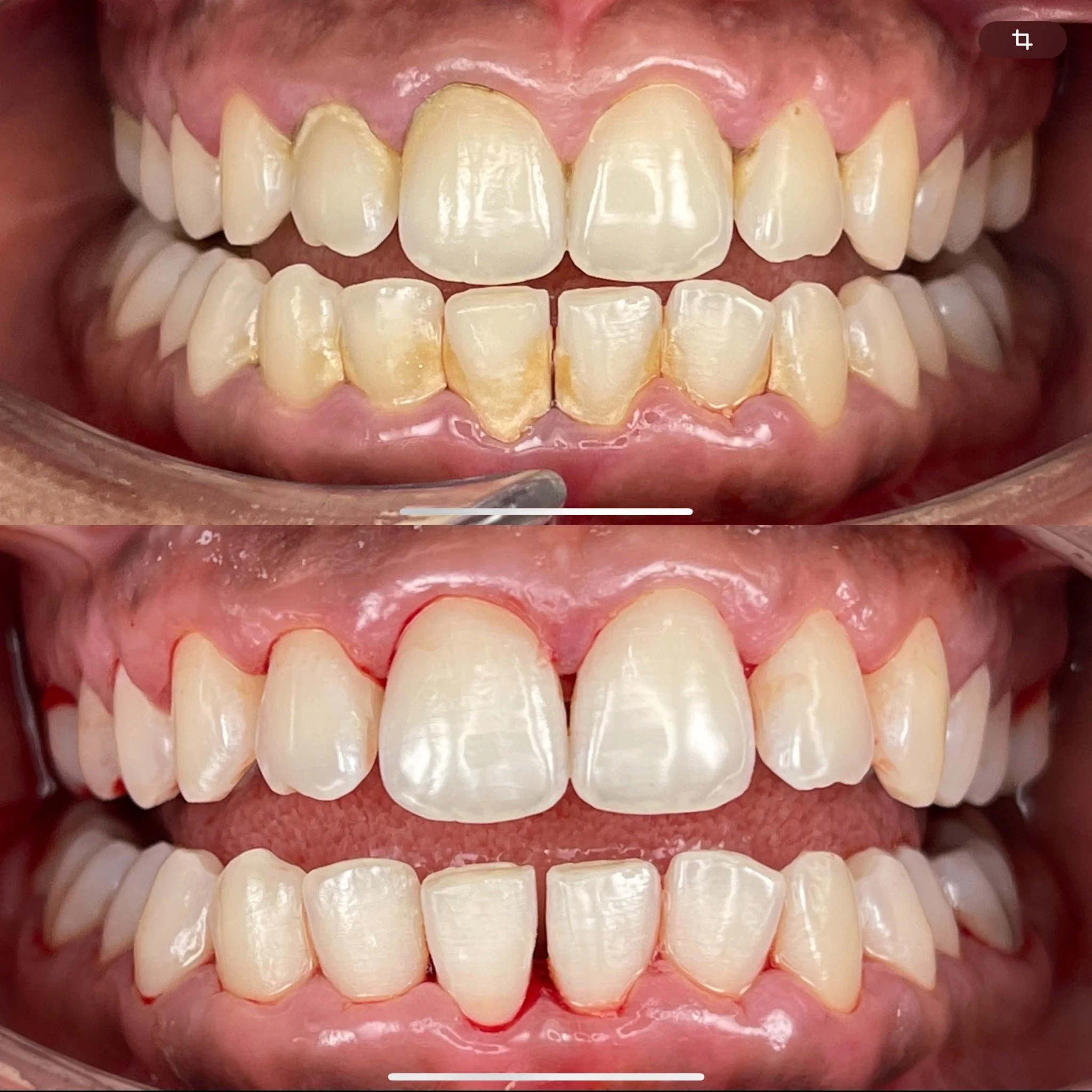 tooth with massive calculus before and immediately after periodontitis treatment 