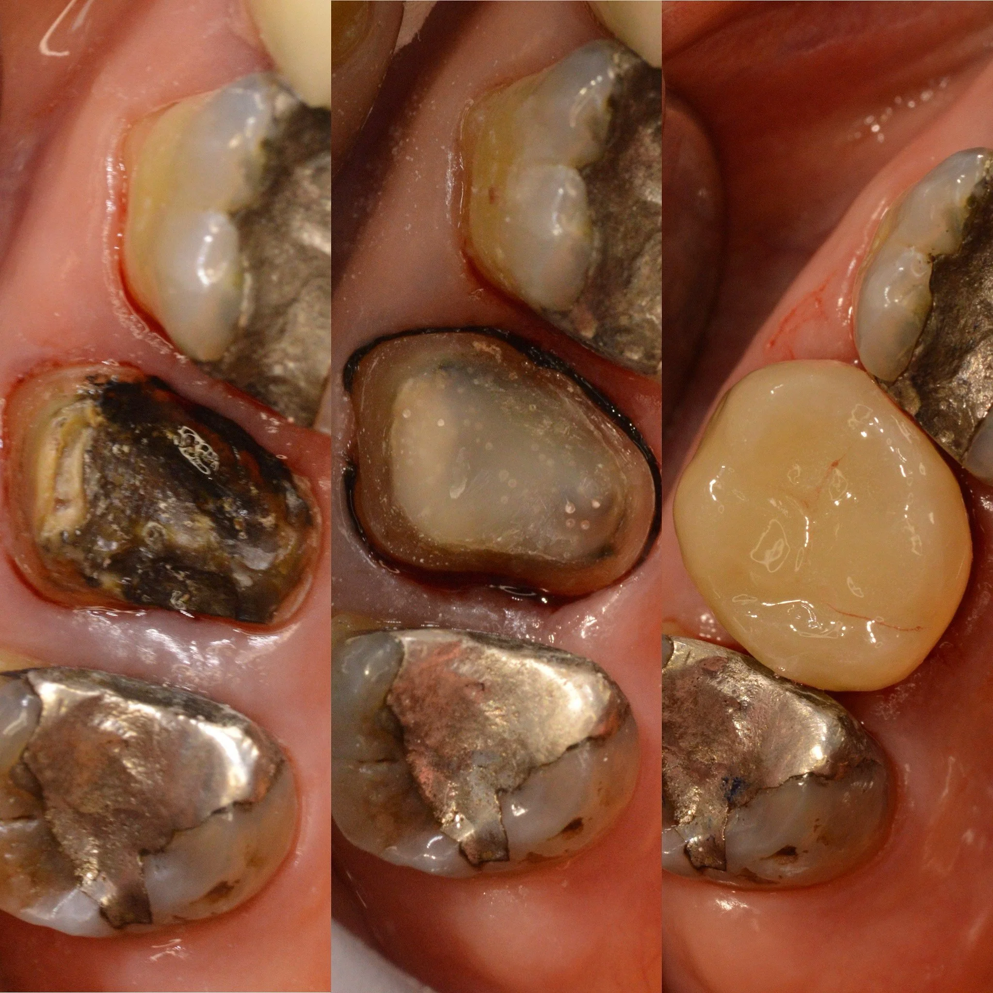 3 comparing Close-up images of the same tooth right after it lost the crown, then restored with filling and restored a ceramic crown