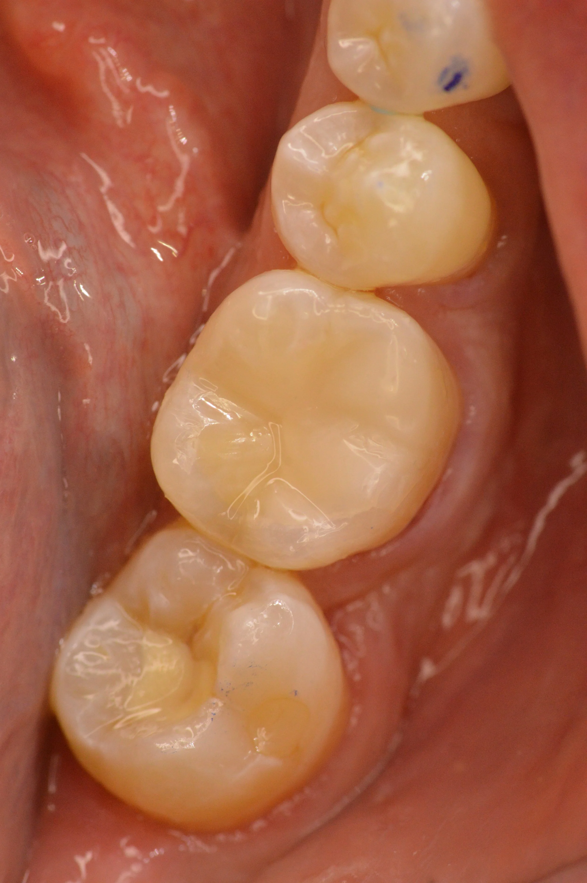 Close-up of human lower molars in the mouth, showing multiple healthy teeth with a new composite filling with an anatomical surface  and pink gums.