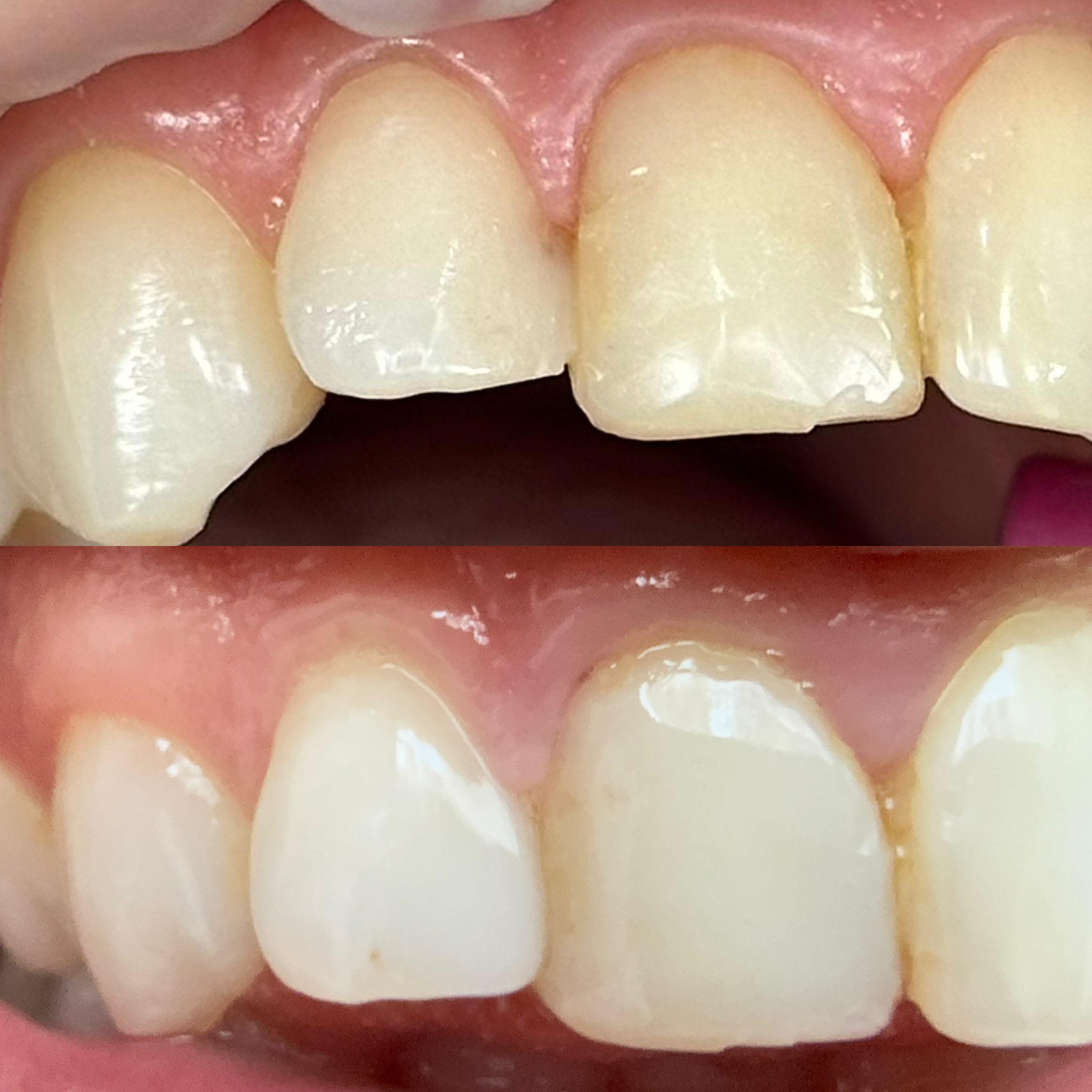 front tooth composite filling