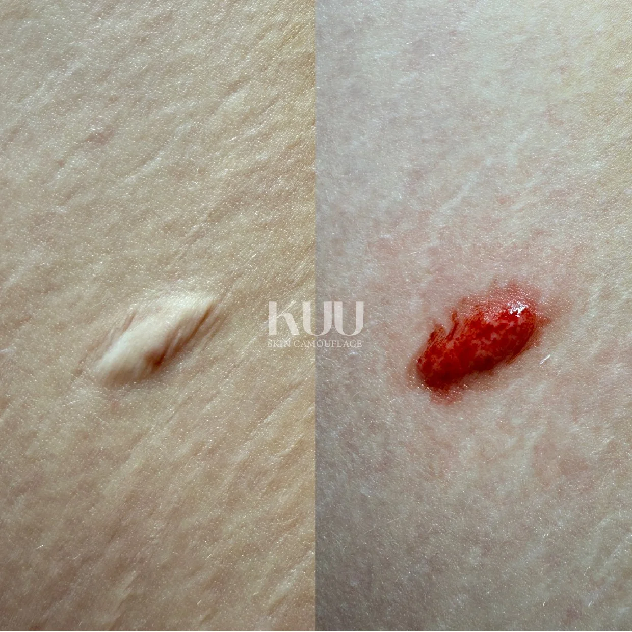 Before and immediately after the first MCA inkless needling session. Two-five sessions recommended.
Mole removal scar. Medical grade serum used in cartridge and massaged into the skin. 
Client goals include breaking down excess collagen to help flatt