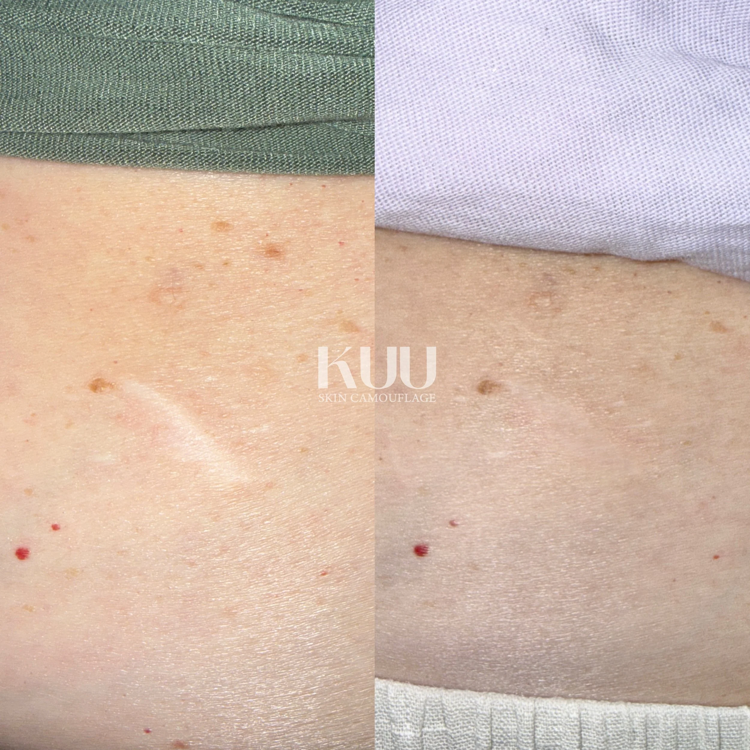 Scar treatment details

- 1 session of MCA inkless medical needling
- 2 sessions of custom ink

*2-5 sessions recommended* 