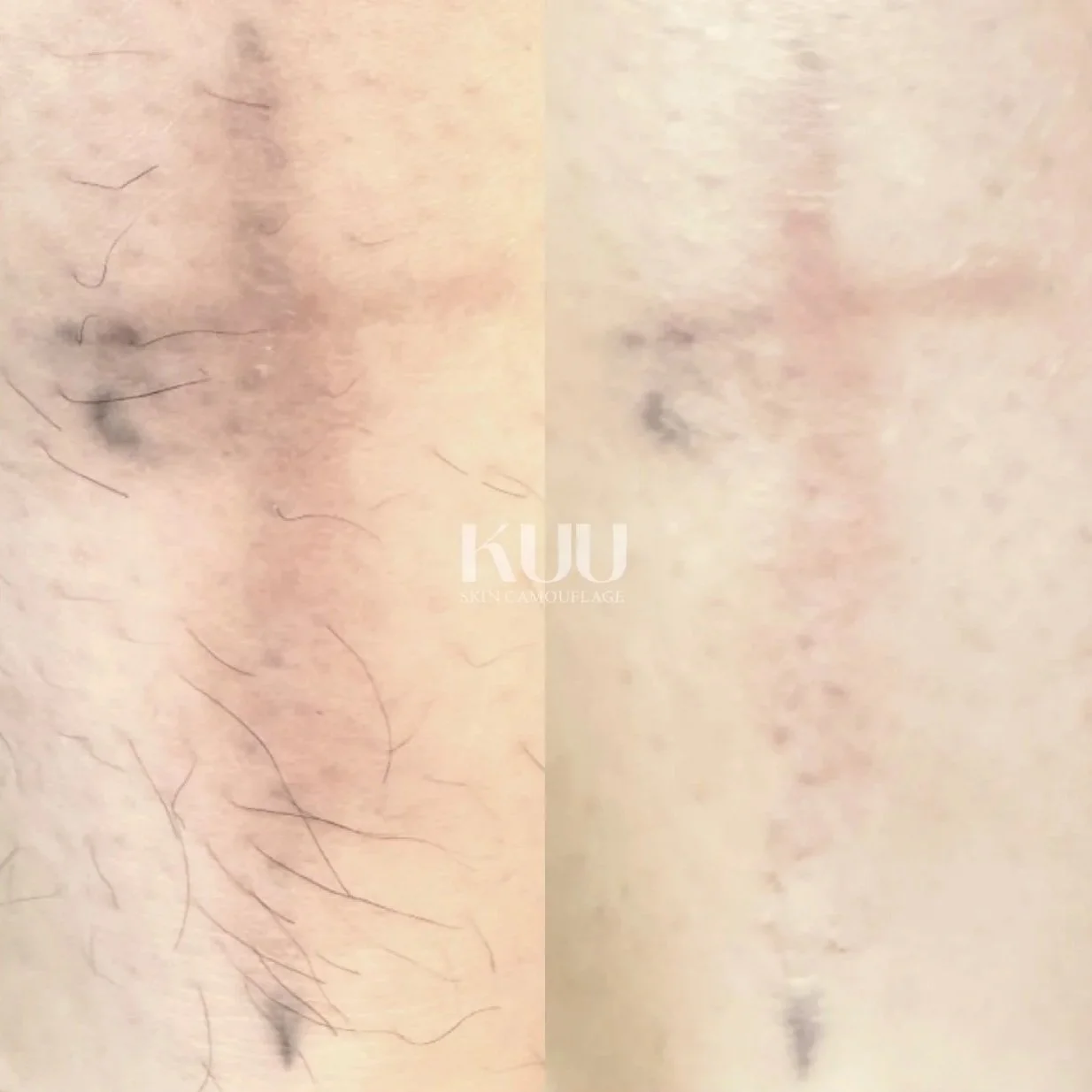 Before and after one session of MCA inkless needling. Two-five sessions recommended.
Previous traditional tattoo removed by tattoo incision. This left discolouration and ink remanence in the skin. 
Client goals were to even out skin pigments and reju