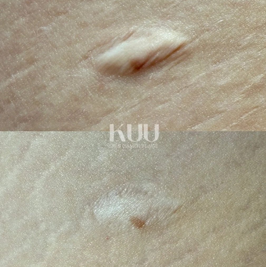 Before and after 3 sessions of MCA inkless needling. Two-five sessions recommended. Mole removal scar. Medical grade serum used in cartridge and massaged into the skin. Scar has flattened  and softened throughout the sessions. 