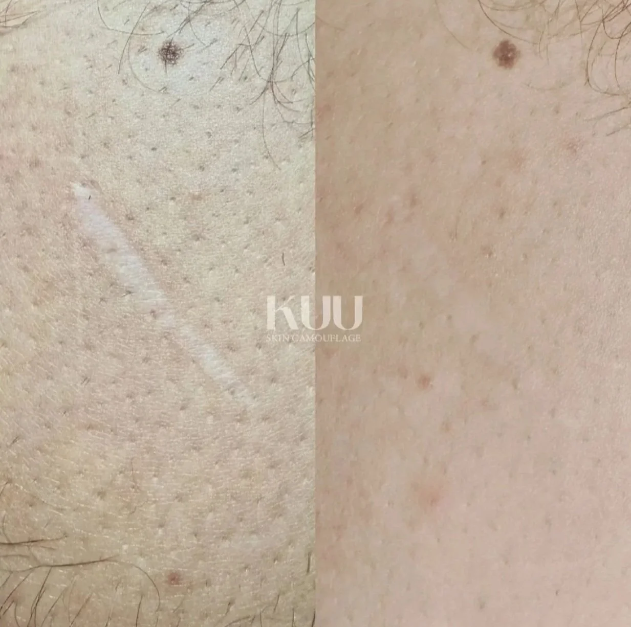 Scar treatment details

- 1 session of MCA inkless medical needling
- 2 sessions of custom ink

*2-5 sessions recommended* 