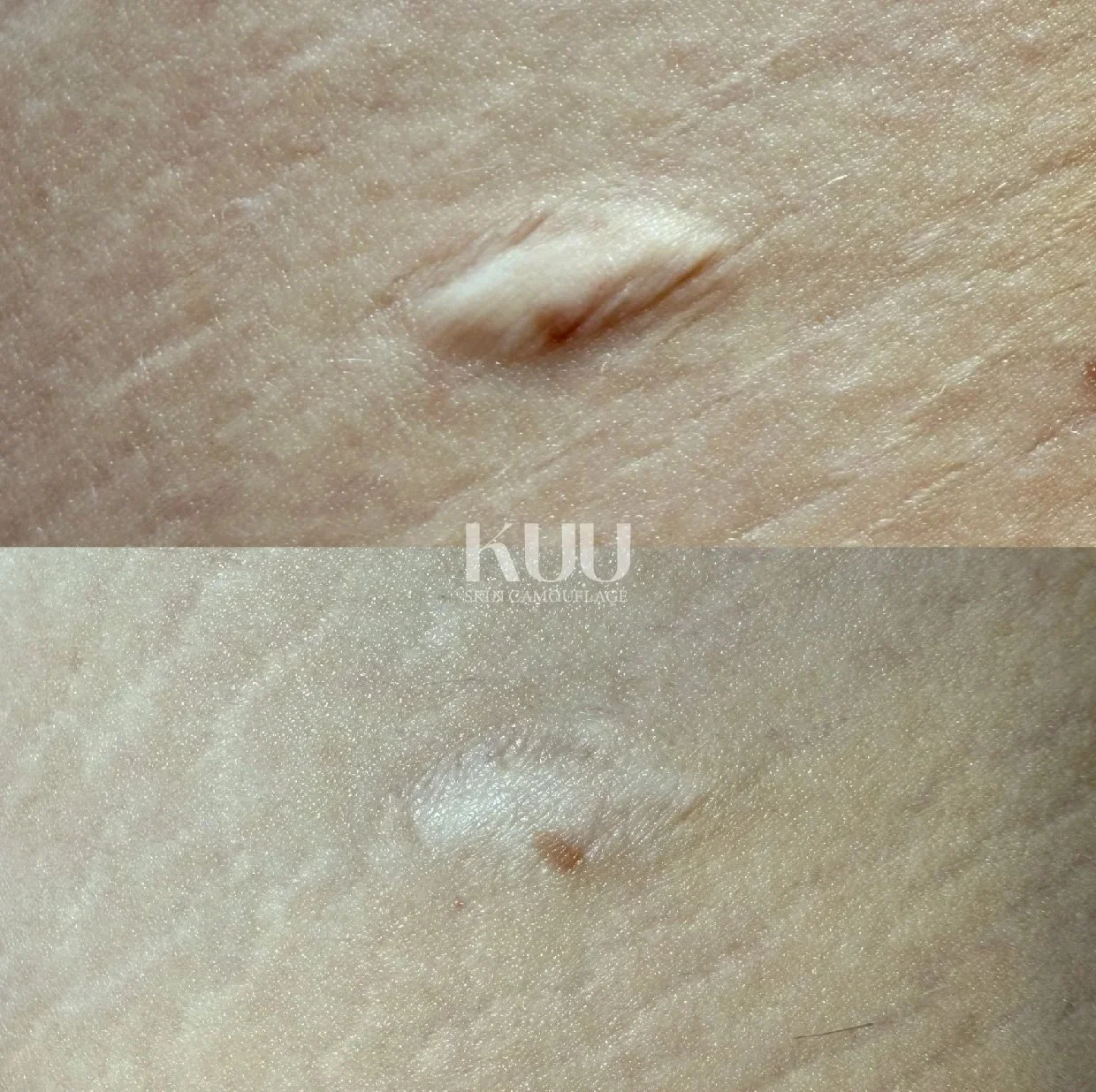Scar treatment details

- 4 session of MCA inkless medical needling

*2-5 sessions recommended* 