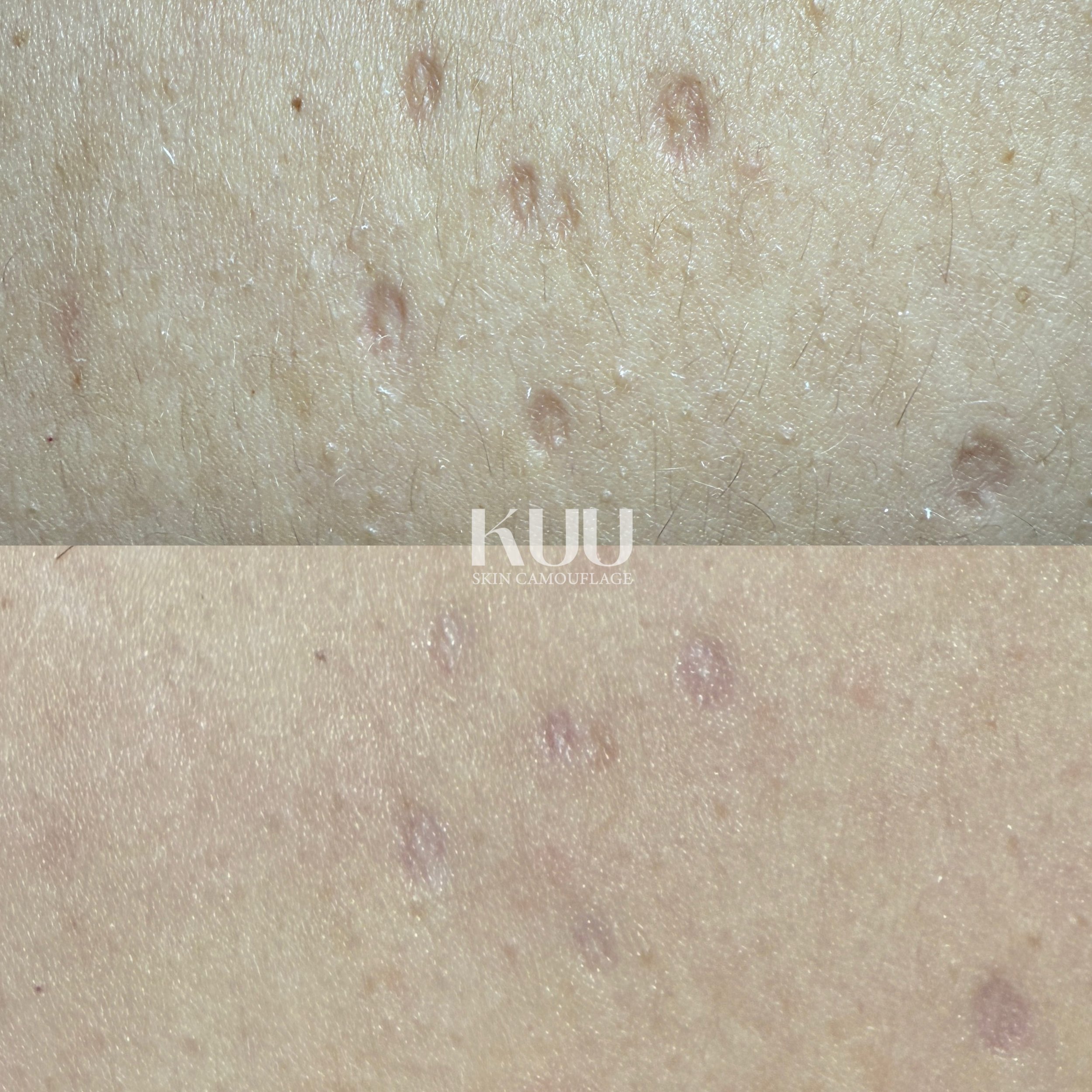 Scar treatment details

- 1 session of MCA inkless medical needling

*2-5 sessions recommended* 