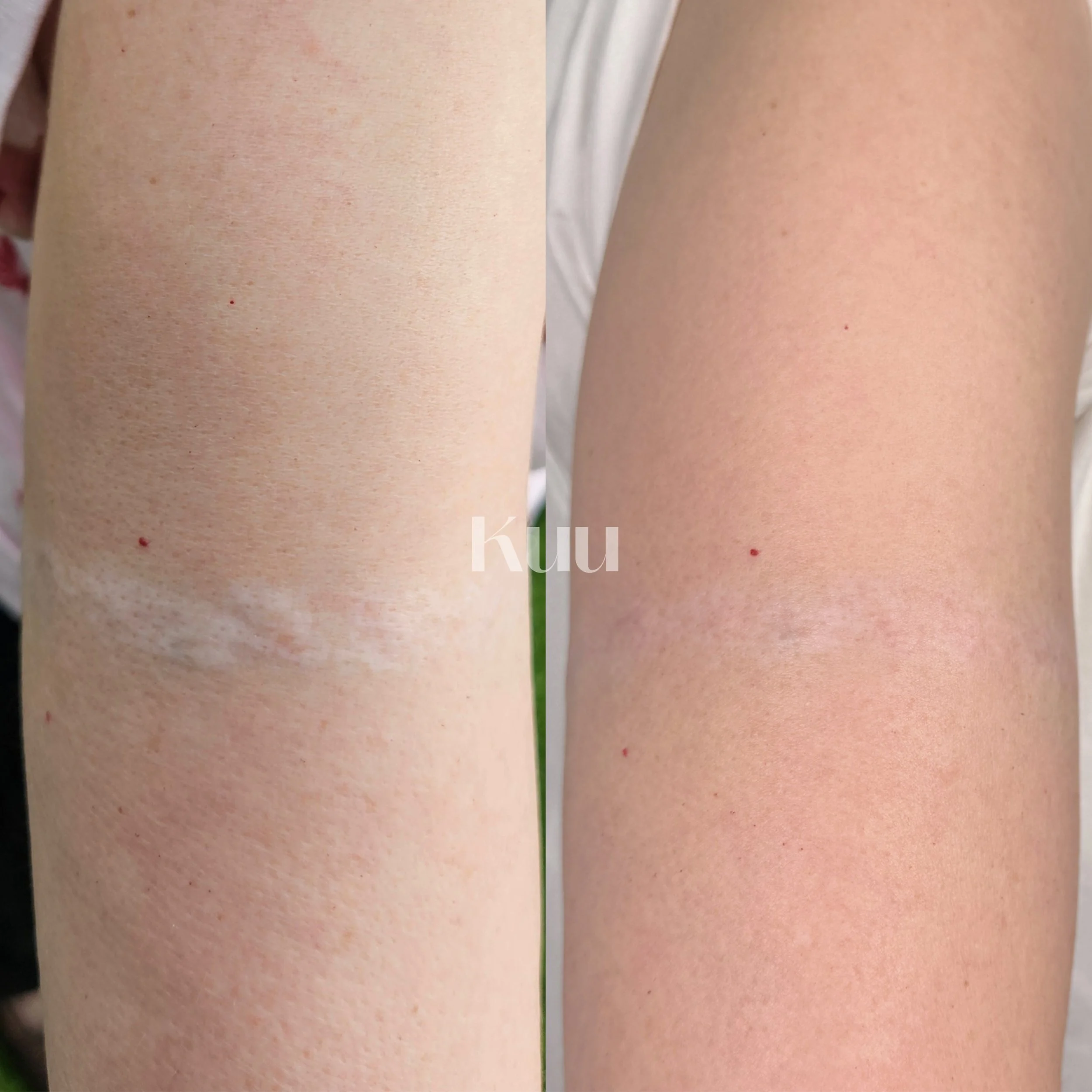 Scar treatment details

- 2 session of MCA inkless medical needling

*2-5 sessions recommended* 