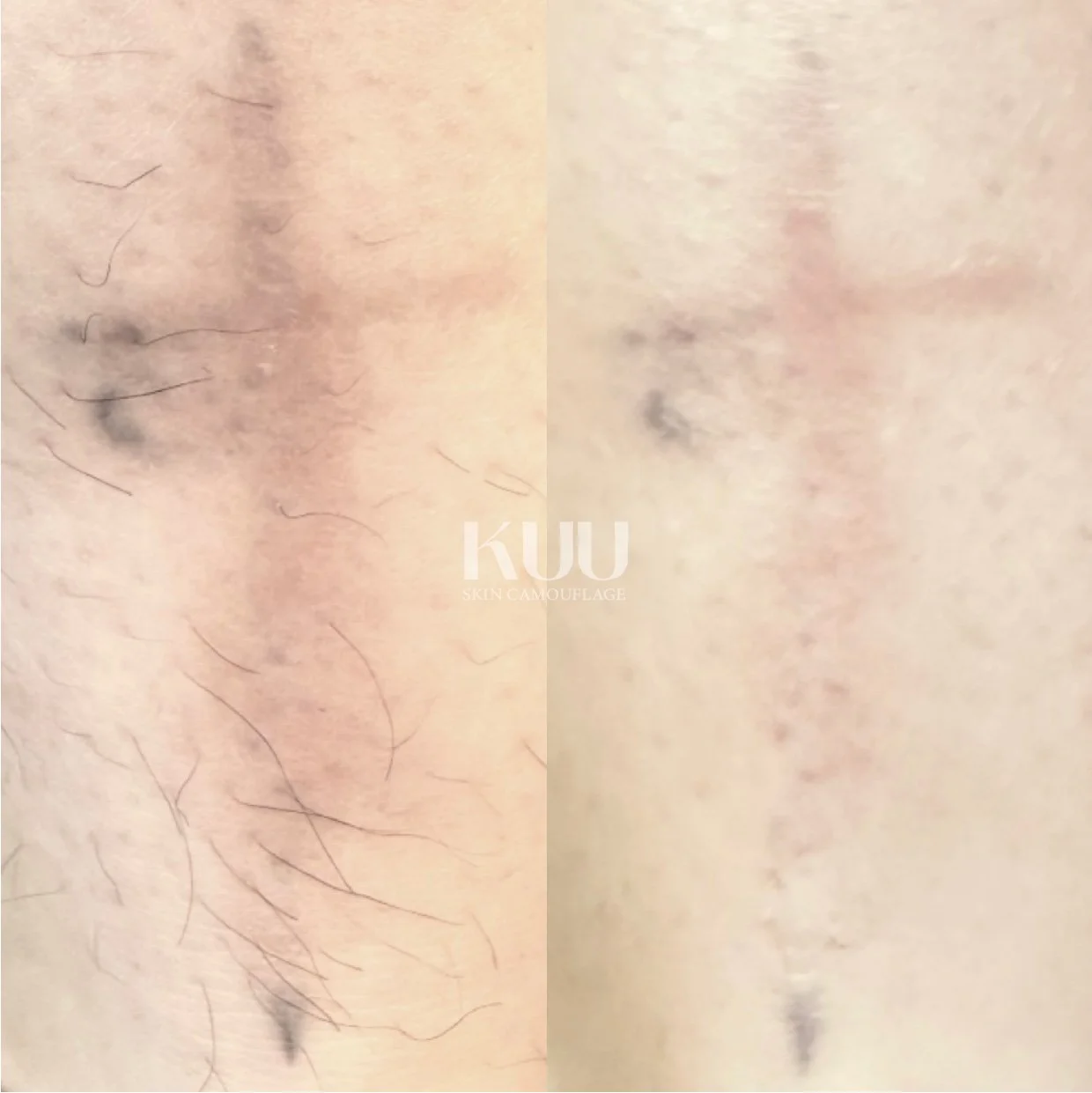 Scar treatment details

- 1 session of MCA inkless medical needling

*2-5 sessions recommended* 