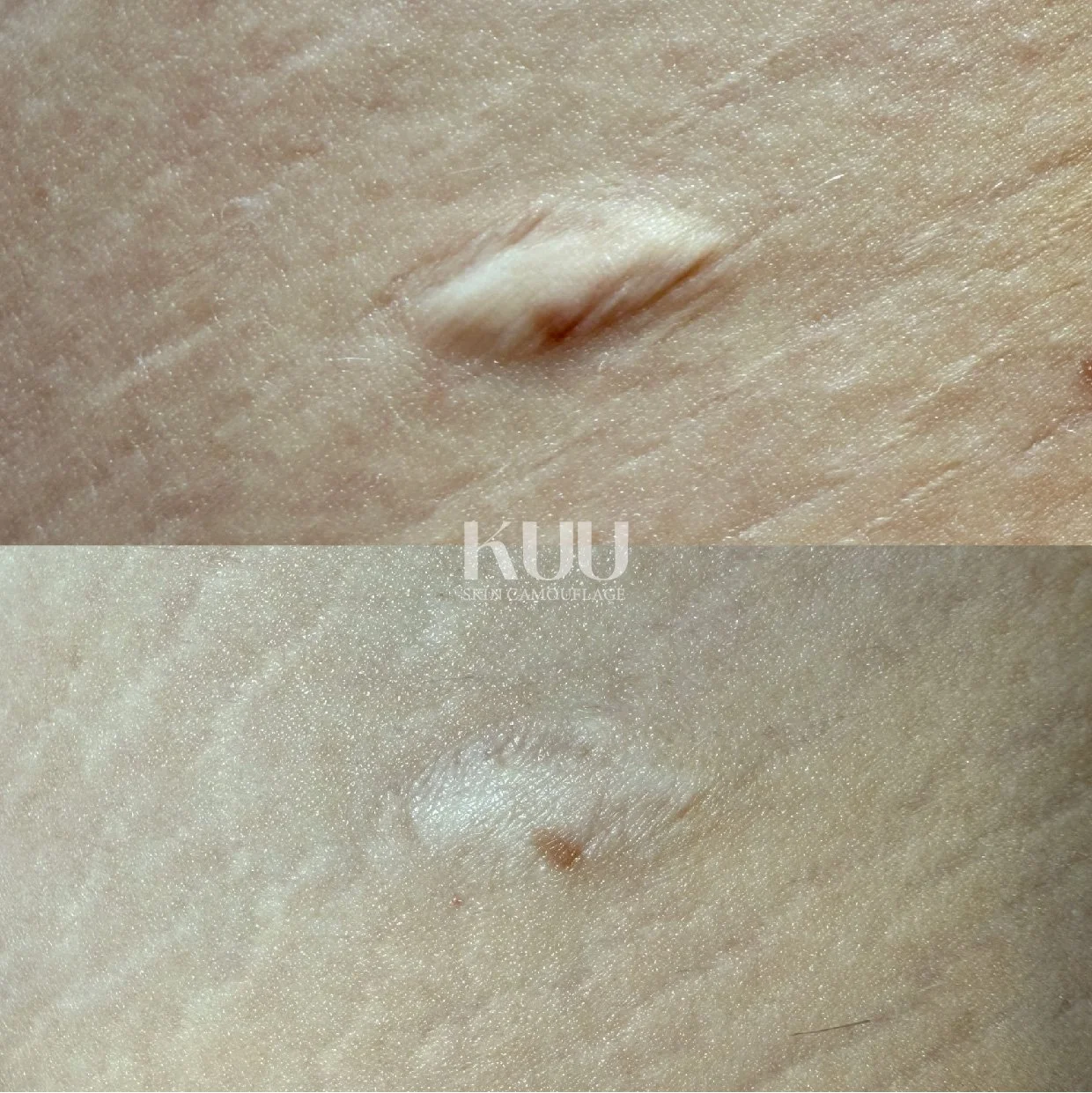 MCA Inkless Needling Portfolio