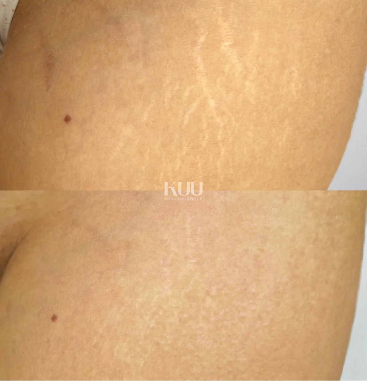 Scar treatment details

- 1 session of stretch mark reduction

*2-5 sessions recommended* 