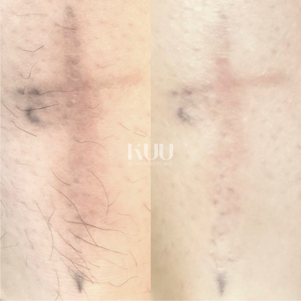 MCA Inkless Needling Portfolio