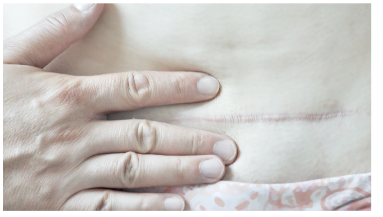 Scar tissue massage can be important after surgeries for a better recovery. 