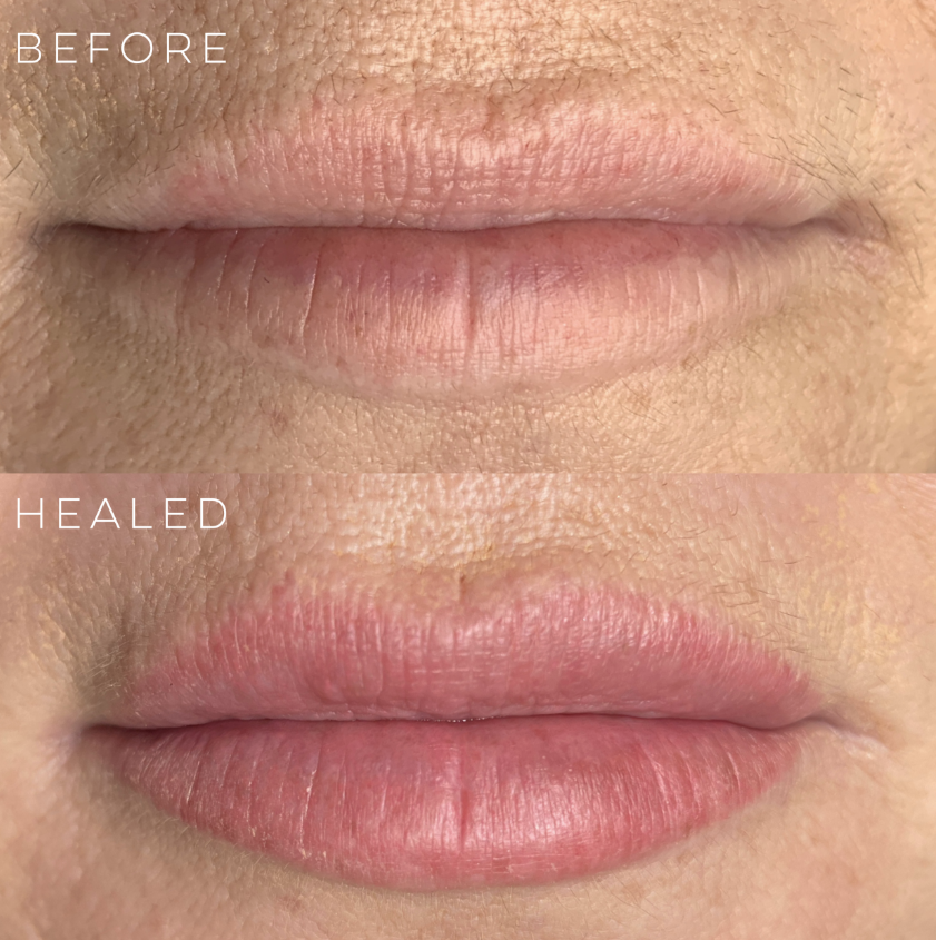 Close-up of lips showing before and healed states, with the healed lips appearing plumper and more moisturized.