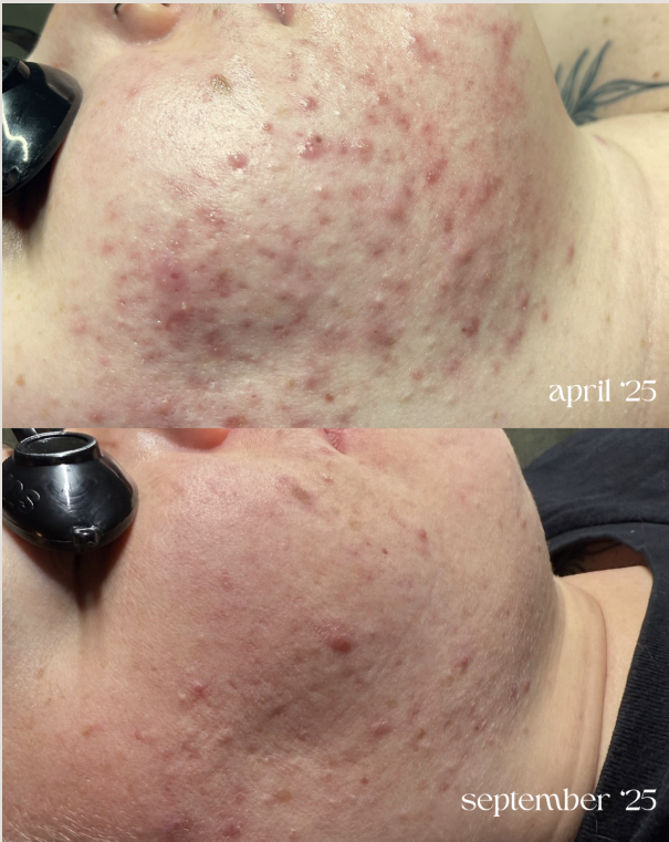 Close-up of a person's skin showing acne scars and blemishes, with comparison photos labeled April 25 and September 25 indicating skin improvement over five months.