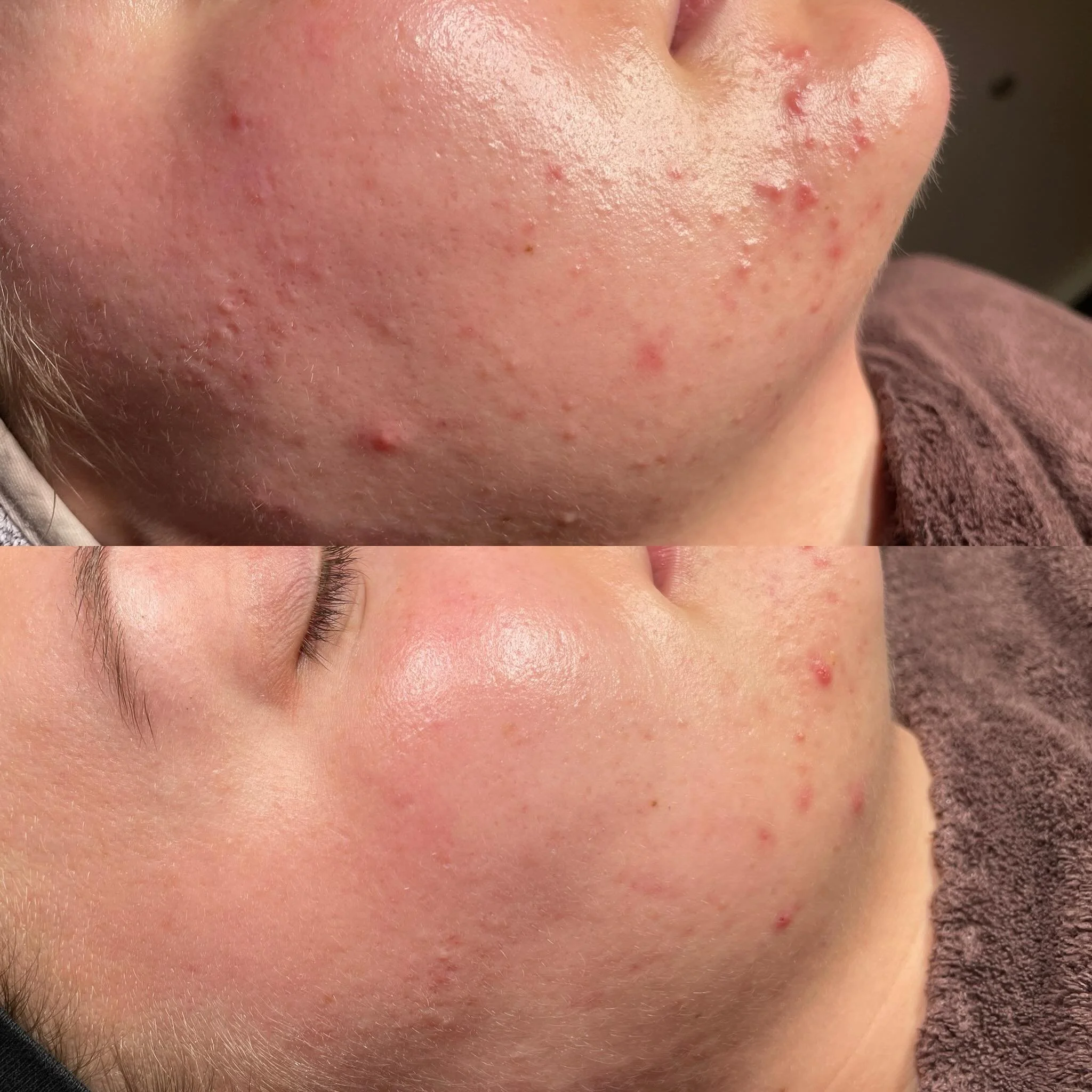 Close-up of a person's cheek showing before and after treatment of acne, with the skin appearing clearer and smoother in the after photo.