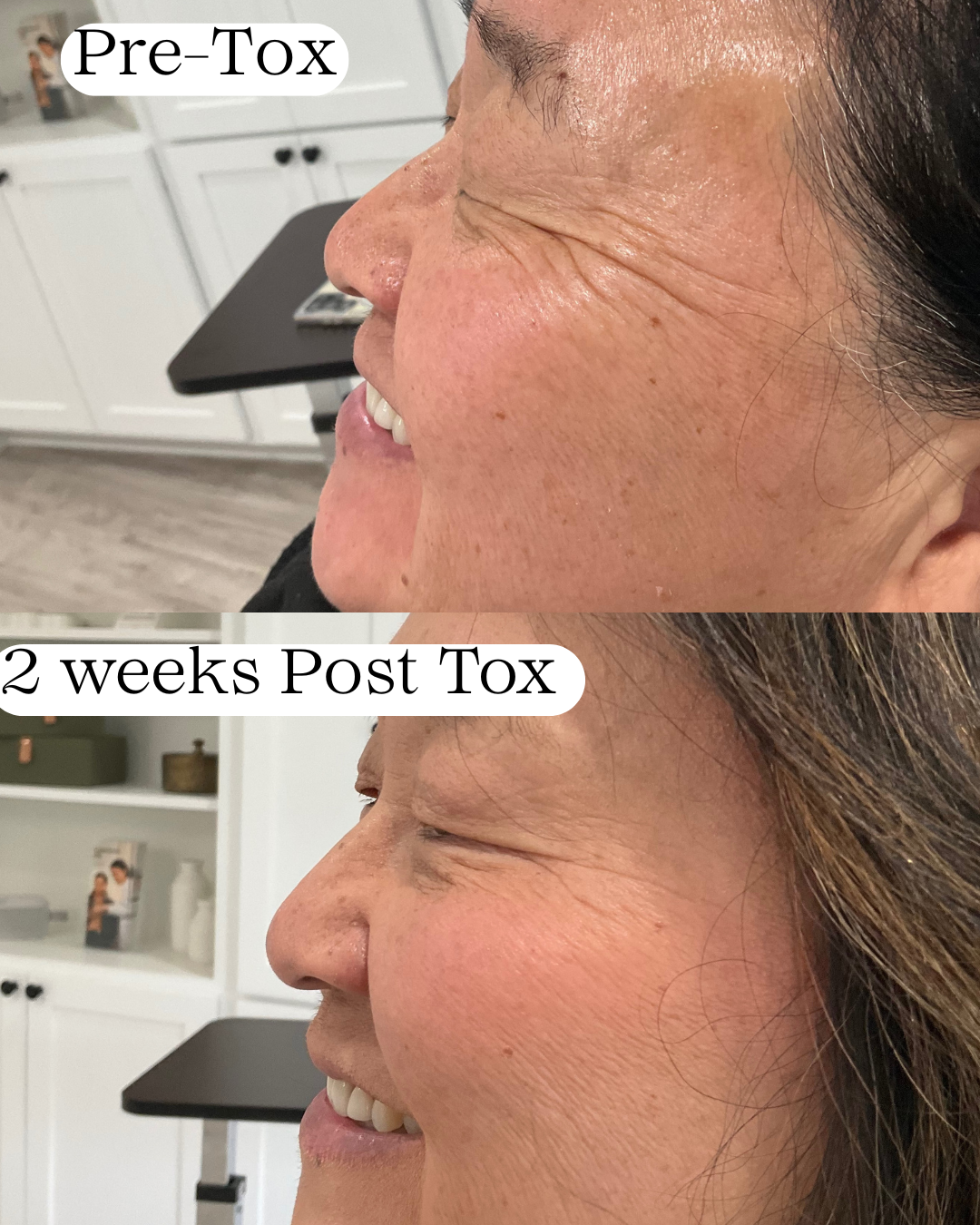 Side-by-side comparison of a woman's face before and after 2 weeks post Botox treatment, showing reduced wrinkles and smoother skin.