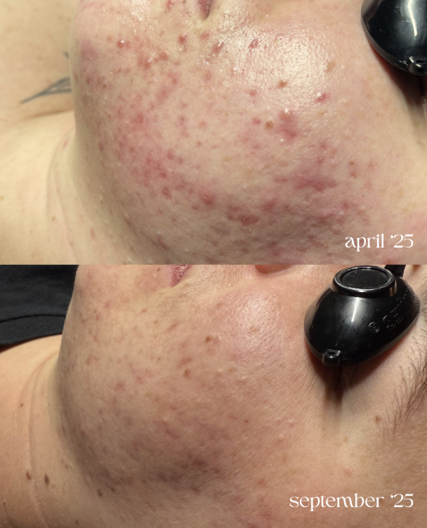 Comparison of a person's cheek showing significant improvement in acne and skin redness from April 2025 to September 2025.