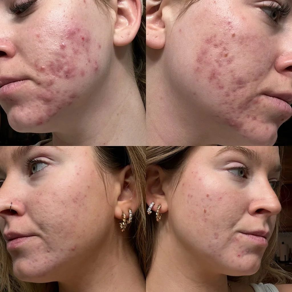 Close-up of a woman's face showing before and after treatment for acne, with visible improvement in skin condition.