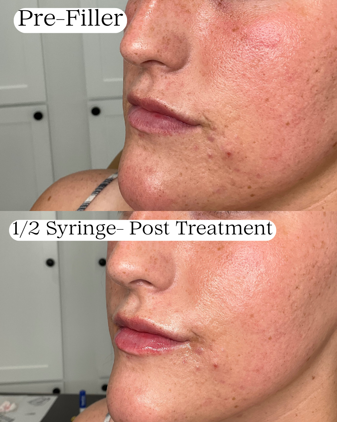 Close-up comparison of a woman's facial skin before and after filler treatment. The top image shows the skin with visible pores and slight unevenness, labeled 'Pre-Filler'. The bottom image shows smoother skin with improved texture and plumpness, labeled '1/2 Syringe- Post Treatment'.