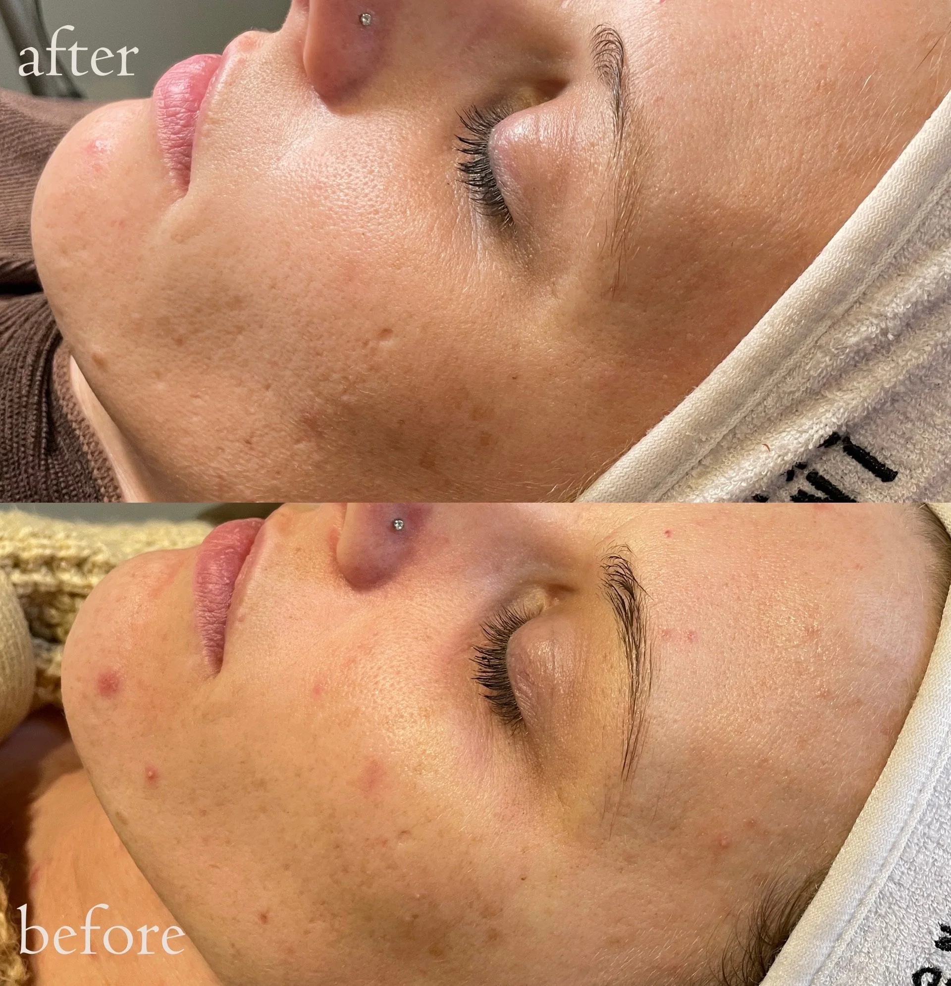 Comparison of a person's face before and after a skincare treatment, showing improved skin texture and reduced blemishes in the after image.