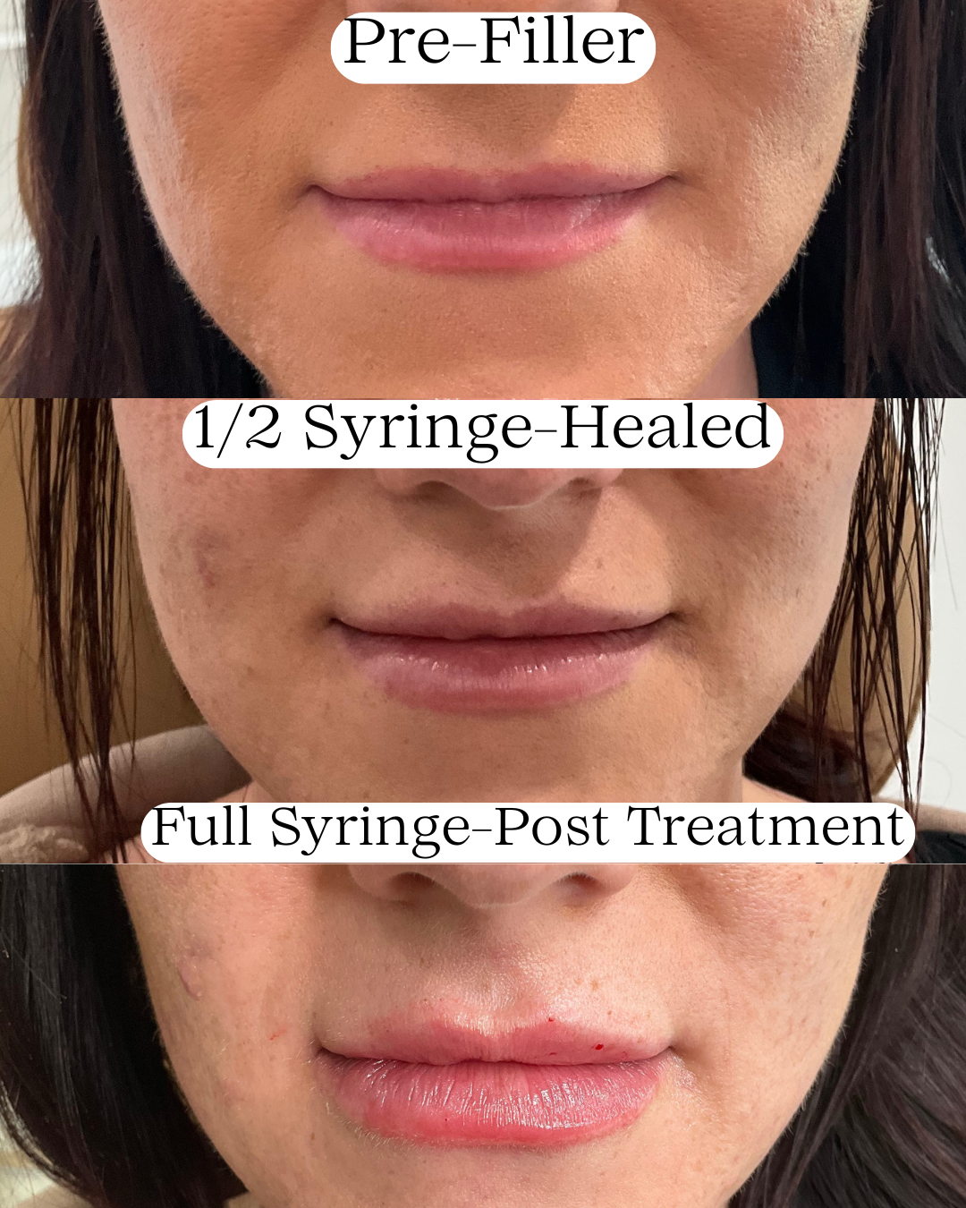 A series of three close-up photos of a woman's lips showing changes before and after a cosmetic procedure. Top: lips before filler, middle: lips after half syringe healed, bottom: lips after full syringe post treatment.