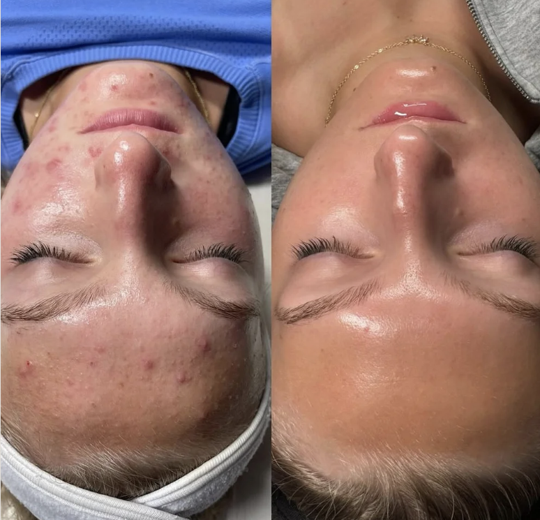 Side-by-side comparison of a person's face before and after skincare treatment, showing reduced acne and smoother skin in the after image.