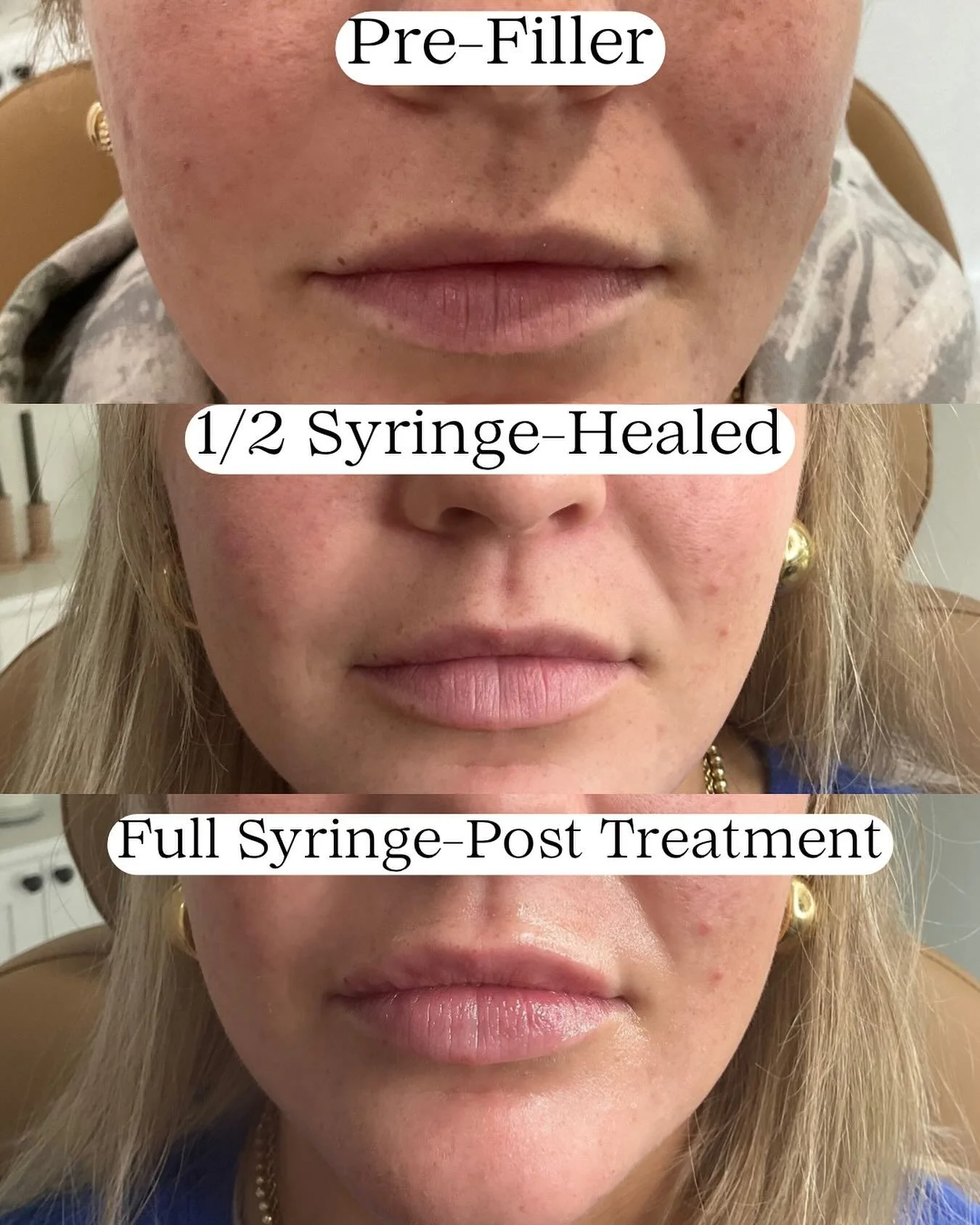 A three-panel sequence showing the progression of a person's lips before and after a cosmetic filler treatment. The first panel shows the lips pre-filler, the second shows the lips after half a syringe healed, and the third displays the lips after a full syringe post-treatment.