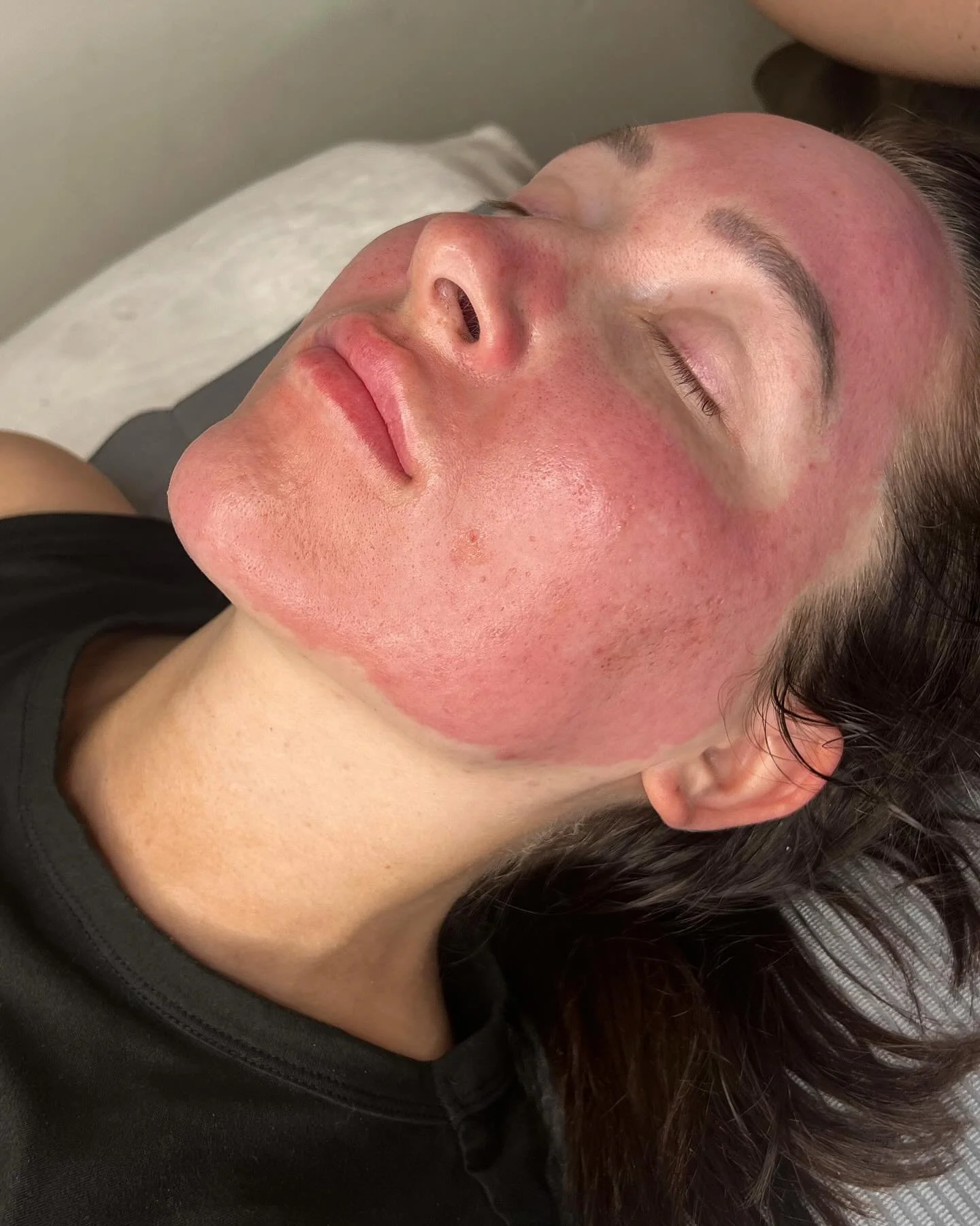 Close-up of a woman with red, irritated skin on her face, lying down with eyes closed.