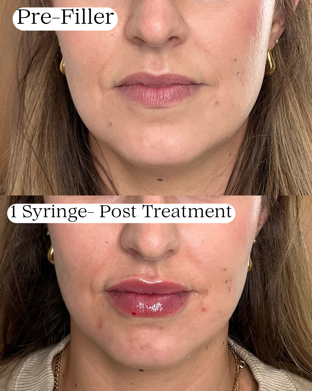 Comparison of lips before and after a cosmetic procedure showing two close-up photos of a woman's mouth, with text labels 'Pre-Filler' at the top and '1 Syringe- Post Treatment' at the bottom, indicating the lip enhancement results.