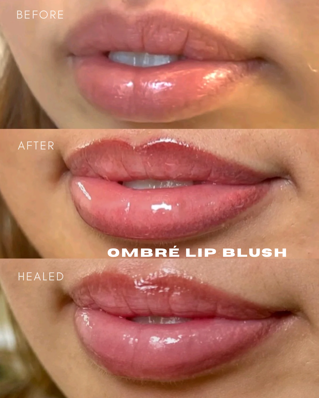 Dark lip neutralization before and after in San Diego for melanin-rich lips.
