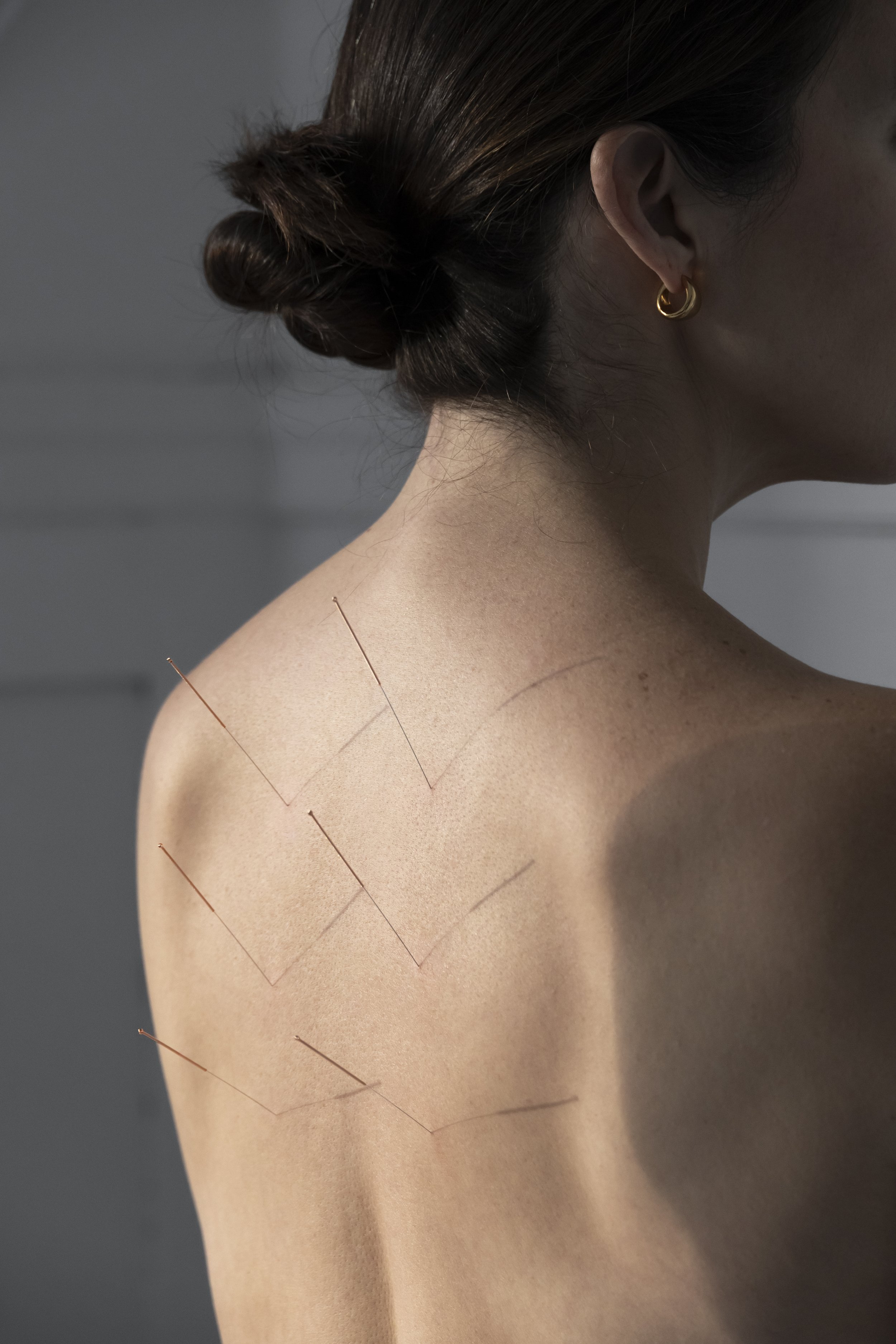 A woman with dark hair styled in a bun, wearing a gold hoop earring, showing her shoulder and back with several thin, metallic acupuncture needles inserted into her shoulder and upper back.