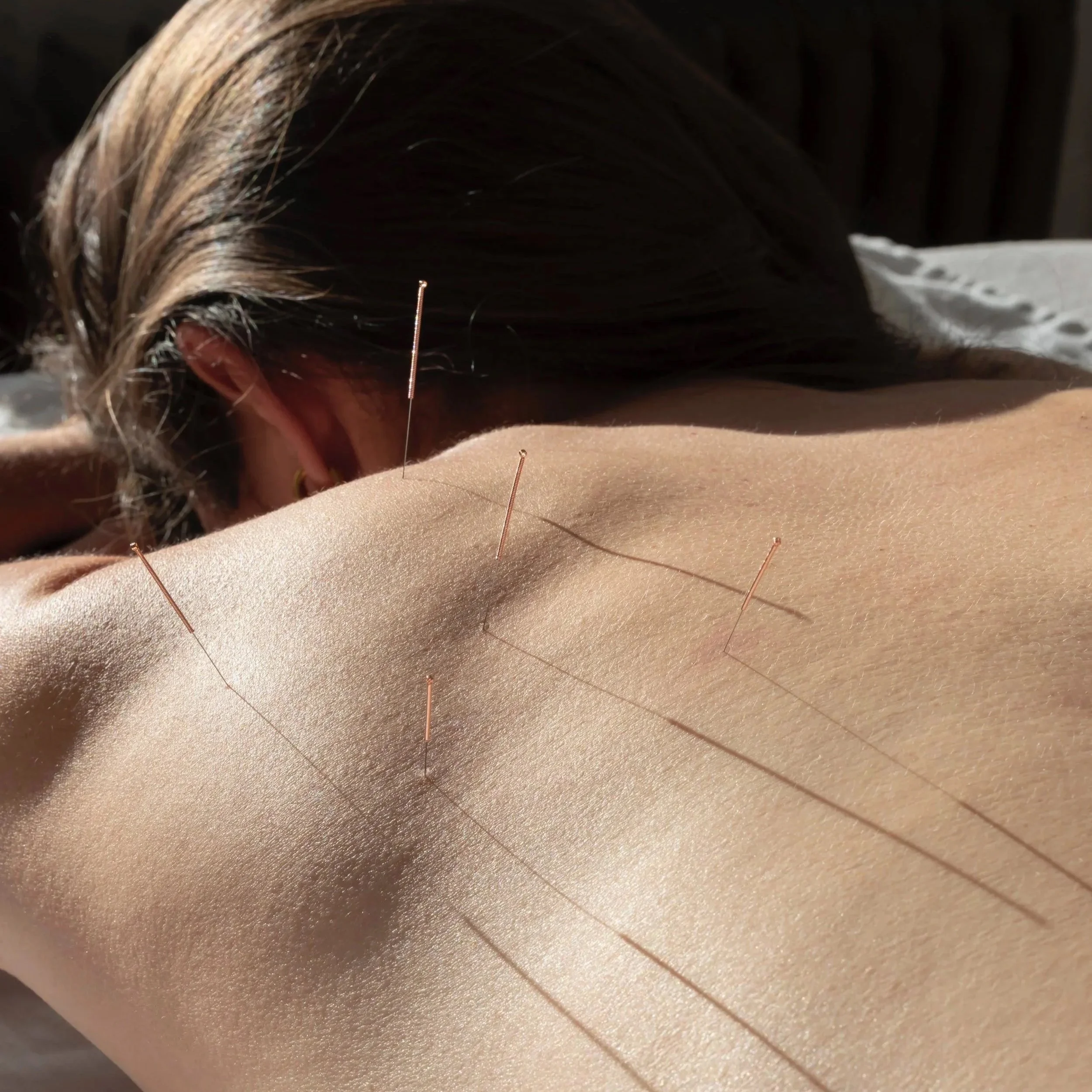 A person lying face down with acupuncture needles inserted into their back, in a well-lit room with a wooden headboard in the background.