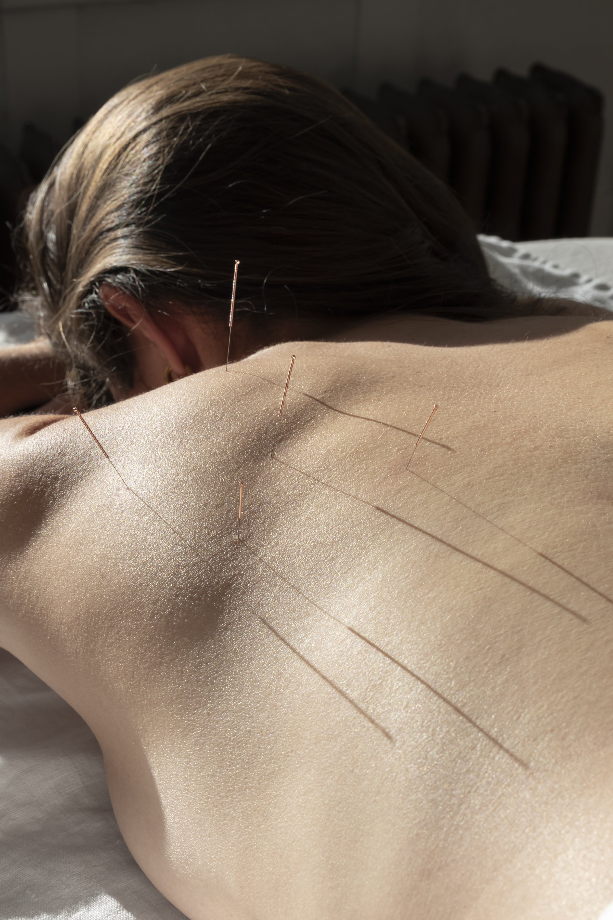 Person lying face down with acupuncture needles inserted into their back, sunlit scene, indoor setting.