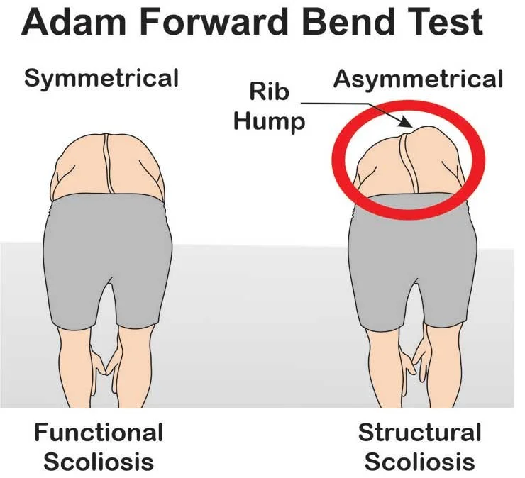 Image courtesy of physio-study.com/, "Adam’s Forward Bend Test"