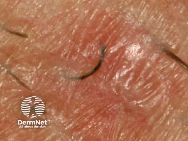 How to Get Rid of Ingrown Hairs: A Complete Guide From a Licensed Esthetician