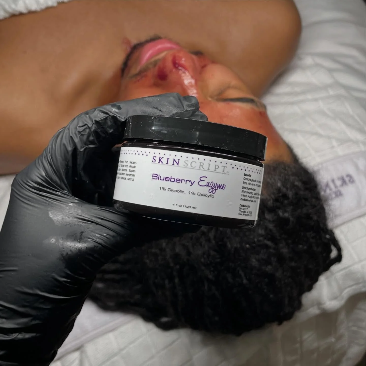 The blueberry enzyme by @skinscript is my secret weapon to treating acne . Glycolic works to bring intense hydration and exfoliation to the skin while salicylic acid balances oil control. This is how I&rsquo;m able to easy extract pimples on the skin