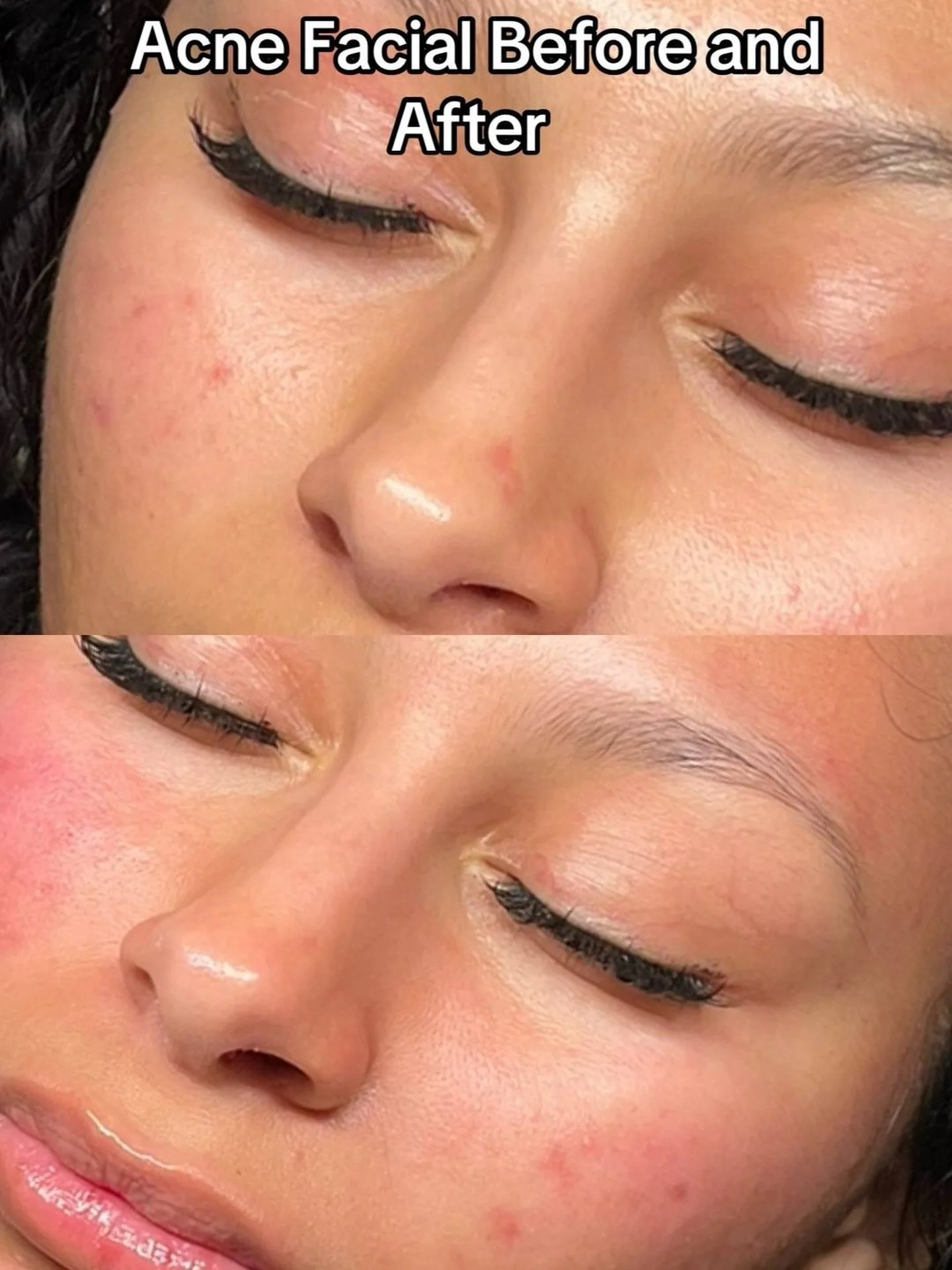 Acne Facials sometimes can leave you red after doing treatment but not because of irritation but increased circulation in the skin. Other than hydration I love using high frequency or enzymes that increase circulation so my clients post facial glow l