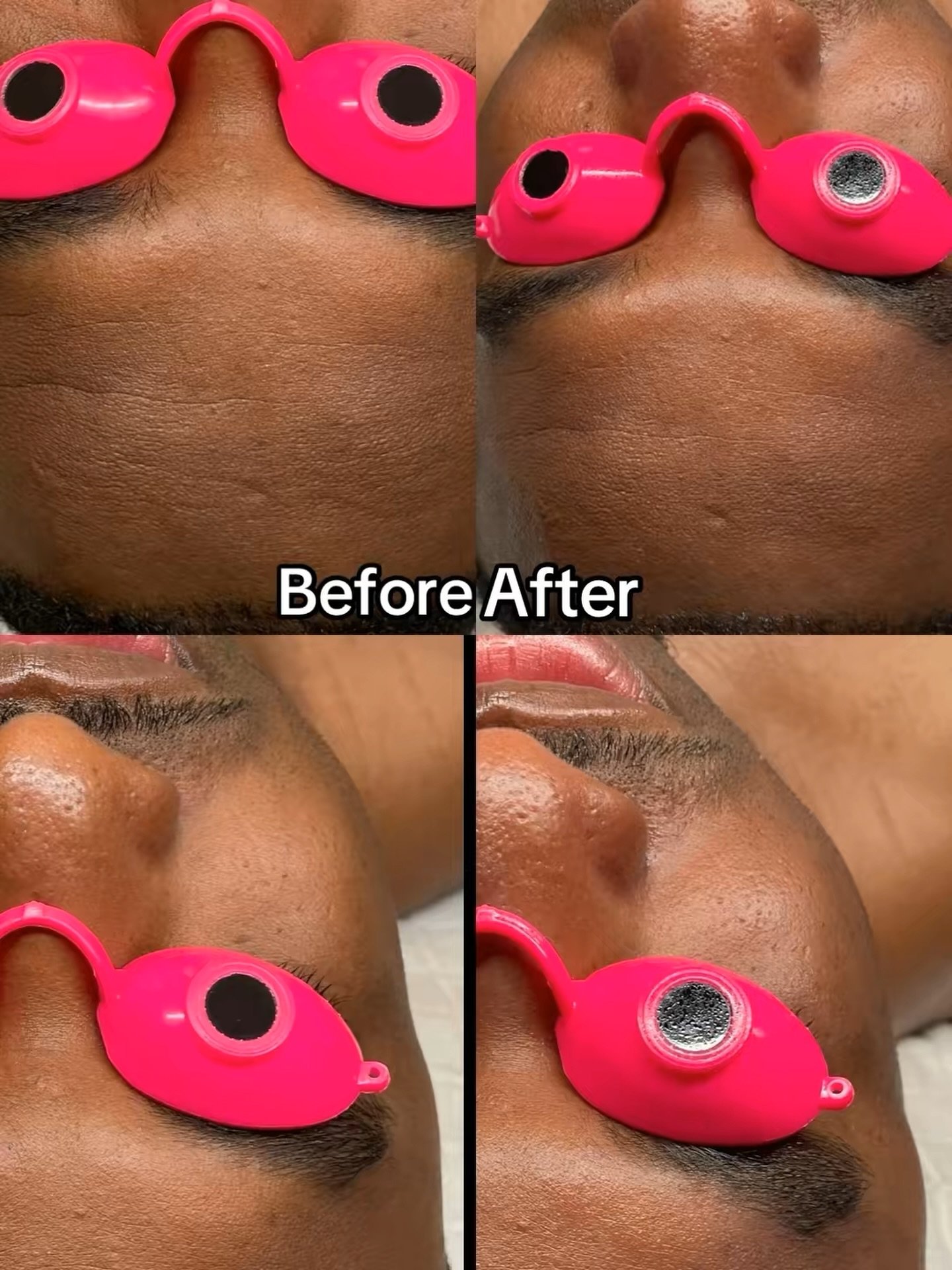 Check out this transformation from a 60min custom facial. During this time we discuss your skin care goals and how we can treat them in and outside the treatment room. 

This picture shows a vas difference in the texture of my clients forehead, and c