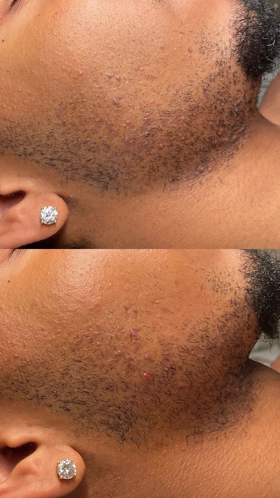 Mens Ingrown Hair Facial Before and After 