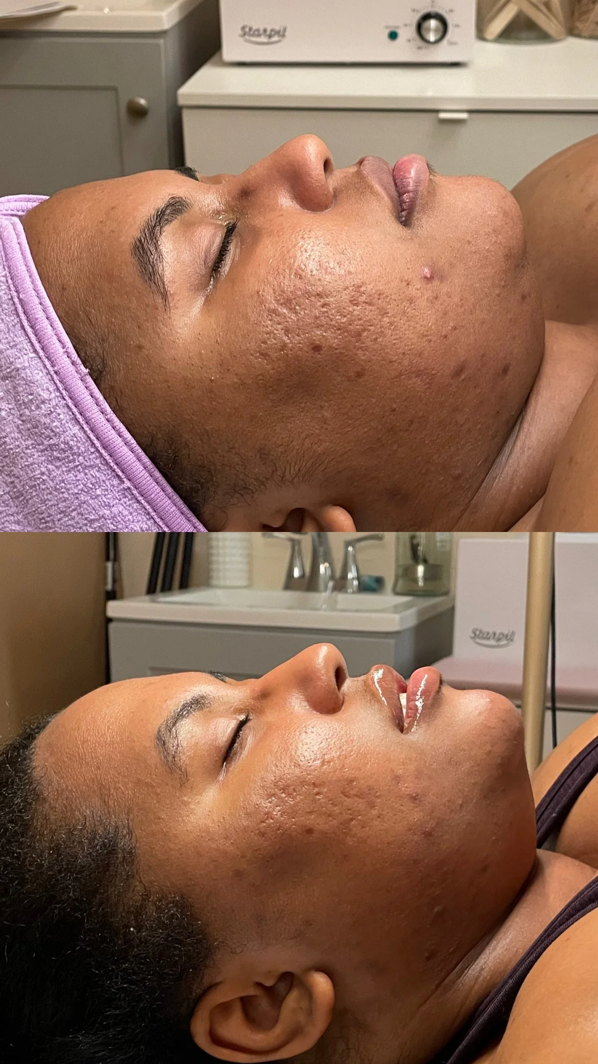 Microdermabrasion Facail Before and After